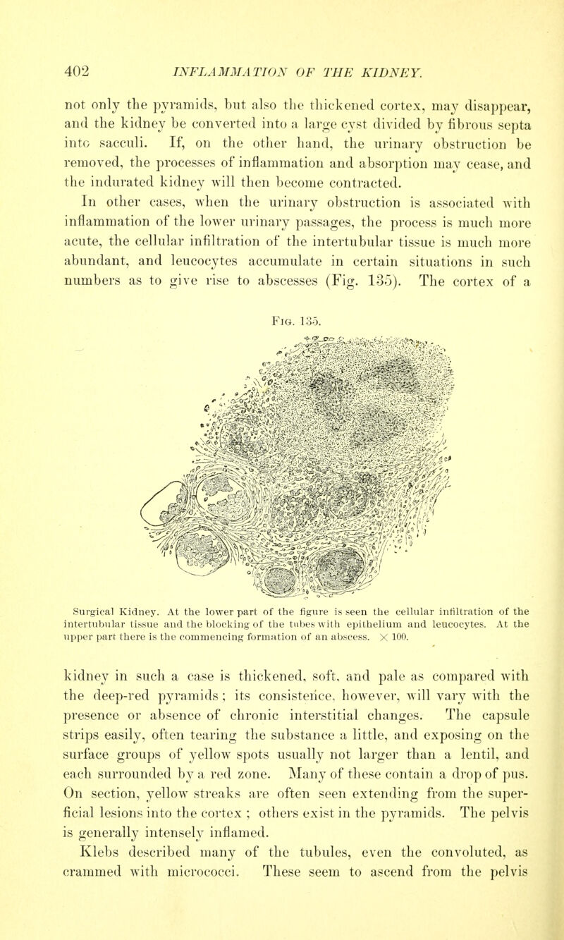 not only the pyramids, but also the thickened cortex, may disappear, and the kidney be converted into a large cyst divided by fibrous septa into sacculi. If, on the other hand, the urinary obstruction be removed, the processes of inflammation and absorption may cease, and the indurated kidney Avill then become contracted. In other cases, when the urinary obstruction is associated with inflammation of the lower urinary passages, the process is much more acute, the cellular infiltration of the intertubular tissue is much more abundant, and leucocytes accumulate in certain situations in such numbers as to give rise to abscesses (Fig. 135). The cortex of a Fig. 135. Surgical Kidney. At the lower part of the figure is seen the cellular intiltration of the intertubular tissue and the blocking of the tubes with epithelium and leucocytes. At the upper part there is the commencing formation of an abscess. X 100. kidney in such a case is thickened, soft, and pale as compared with the deep-red pyramids ; its consistence, however, Avill vary with the presence or absence of chronic interstitial changes. The capsule strips easily, often tearing the substance a little, and exposing on the surface groups of yellow spots usually not larger than a lentil, and each surrounded by a red zone. Many of these contain a drop of pus. On section, yellow streaks are often seen extending from the super- ficial lesions into the cortex ; others exist in the pyramids. The pelvis is generally intensely inflamed. Klebs described many of the tubules, even the convoluted, as crammed with micrococci. These seem to ascend from the pelvis
