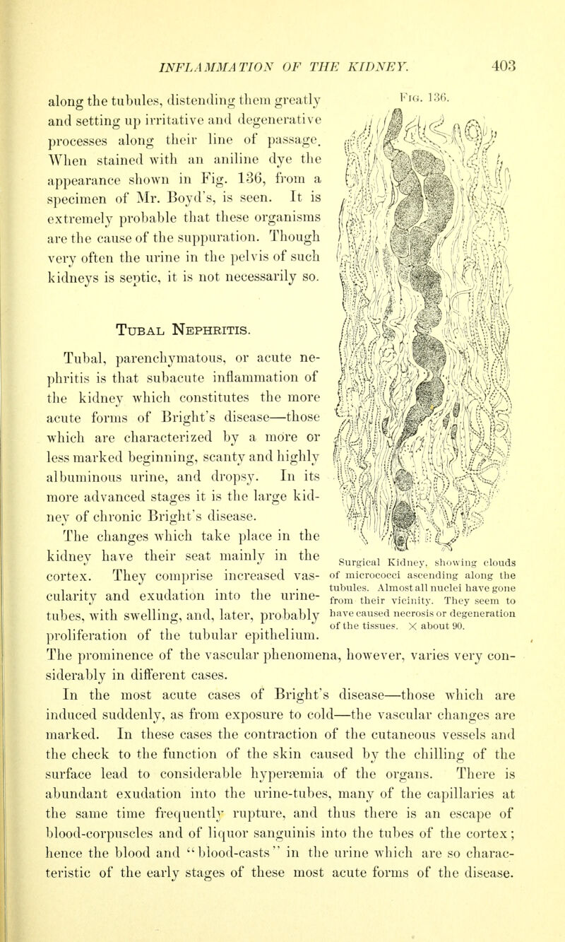 Fig. 136. It ') 4 ^1 /> 1//' ''If} • Ml along the tubules, distending them greatly and setting up irritative and degenerative processes along their line of passage. When stained with an aniline dye the appearance shown in Fig. 136, from a specimen of Mr. Boyd's, is seen. It is extremely probable that these organisms are the cause of the suppuration. Though very often the urine in the pelvis of such kidneys is septic, it is not necessarily so. Tubal Nephritis. Tubal, parenchymatous, or acute ne- phritis is that subacute inflammation of the kidney which constitutes the more acute forms of Bright's disease—those which are characterized by a more or less marked beginning, scanty and highly albuminous urine, and dropsy. In its more advanced stages it is the large kid- ney of chronic Bright's disease. The changes which take place in the kidney have their seat mainly in the surgu-ai K,dno^ si.nvn., clouds cortex. They comprise increased vas- of micrococci ascending along the T ., T n . • , ,1 • tubules. Almost all nuclei have gone cularity and exudation into the urine- f,,,^, vicinity. They seem to tubes, with SWellino;, and, later, probably have caused necrosis or degeneration -IT of the tissues. X about 90. proliferation oi the tubular epithelium. The prominence of the vascular phenomena, however, varies very con- siderably in difterent cases. In the most acute cases of Bright's disease—those which are induced suddenly, as from exposure to cold—the vascular changes are marked. In these cases the contraction of the cutaneous vessels and the check to the function of the skin caused by the chilling of the surface lead to considerable hyperaemia of the organs. There is abundant exudation into the urine-tubes, many of the capillaries at the same time frequently rupture, and thus there is an escape of blood-corpuscles and of liquor sanguinis into the tubes of the cortex; hence the blood and blood-casts in the urine which are so charac- teristic of the early stages of these most acute forms of the disease.