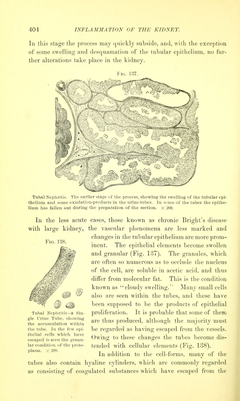 In this stage the process may quickly subside, and, with the exception of some swelling and desquamation of the tubular epithelium, no fur- ther alterations take place in the kidney. Tubal Nephritis. The earlier stage of the process, showing the swelling of the tubular epi- thelium and some exudation-products in the urine-tubes. In some of the tubes the epithe- lium has fallen out during the preparation of the section, x 200. In the less acute cases, those known as chronic Bright's disease with large kidney, the vascular phenomena are less marked and changes in the tubular epithelium are more prom- inent. The epithelial elements become swollen and granular (Fig. 137). The granules, which are often so numerous as to occlude the nucleus of the cell, are soluble in acetic acid, and thus differ from molecular fat. This is the condition known as cloudy swelling. IMany small cells also are seen within the tubes, and these have been supposed to be the products of epithelial proliferation. It is probable that some of them are thus produced, although the majority must be regarded as having escaped from the vessels. Owino; to these chano;es the tubes become dis- tended with cellular elements (Fig. 138). In addition to the cell-forms, many of the tubes also contain hyaline cylinders, which are commonly regarded as consisting of coagulated substances which have escaped from the Tubal Nephritis—a Sin- gle Urine Tube, showing the accumulation within the tube. In the few epi- thelial cells which have escaped is seen the granu- lar condition of the proto- plasm. X 200.