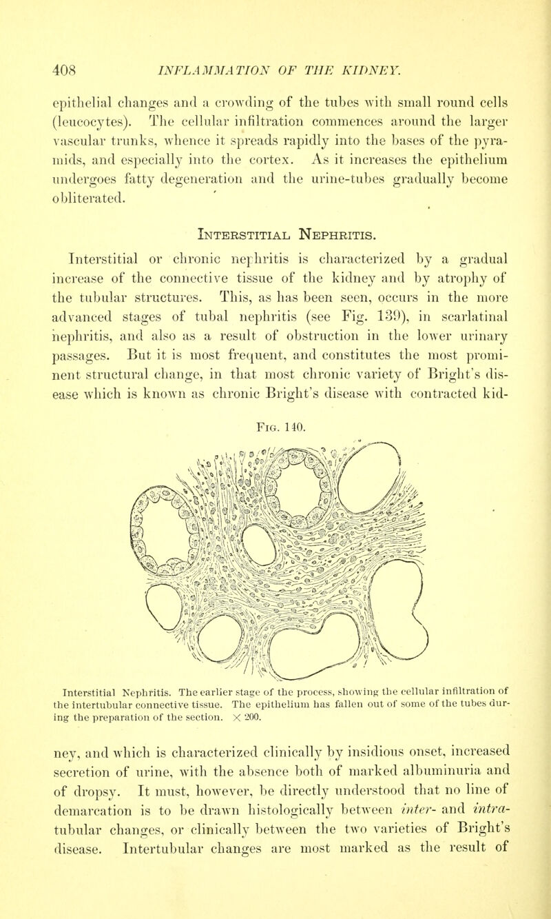 epithelial changes and a crowding of the tubes with small round cells (leucocytes). The cellular infiltration commences around the larger vascular trunks, whence it spreads rapidly into the bases of the ])yra- mids, and especially into the cortex. As it increases the epithelium undergoes fatty degeneration and the urine-tubes gradually become obliterated. Interstitial Nephritis. Interstitial or chronic nephritis is characterized by a gradual increase of the connective tissue of the kidney and by atrophy of the tubular structures. This, as has been seen, occurs in the more advanced stages of tubal nephritis (see Fig. 139), in scarlatinal nephritis, and also as a result of obstruction in the lower urinary passages. But it is most frequent, and constitutes the most promi- nent structural change, in that most chronic variety of Bright's dis- ease which is known as chronic Bright's disease with contracted kid- FiG. 140. Interstitial Nephritis. The earlier stage of the process, showing the cellular Infiltration of the intertnbular connective tissue. The epithelium has fallen out of some of the tubes dur- ing the preparation of the section. X 200. ney, and which is characterized clinically by insidious onset, increased secretion of urine, w4th the absence both of marked albuminuria and of dropsy. It must, however, be directly understood that no line of demarcation is to be drawn histologically between inter- and intra- tubular changes, or clinically between the two varieties of Bright's disease. Intertubular changes are most marked as the result of
