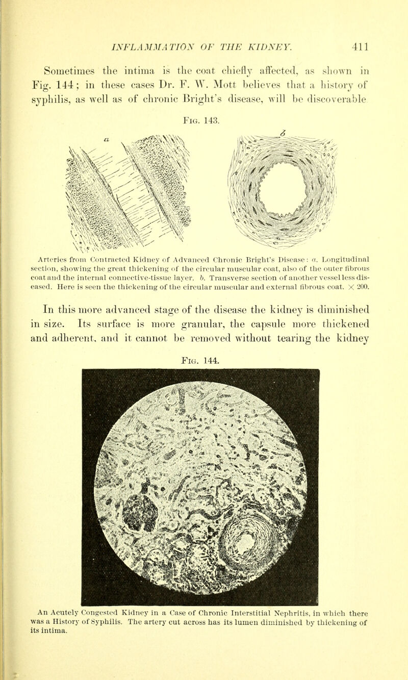 Sometimes the intima is the coat chiefly aff'ected, as sliown in Fig. 144; in these cases Dr. F. W. Mott believes that a history of syphilis, as well as of chronic Bright's disease, Avill be discoverable Fig. 143. Arteries from (;(>iitracte(i Kidney of Advanced Chronic Bright's Disease: a. Longitudinal section, showing the great thiclvcning of the circular muscular coat, also of the outer fibrous coat and the internal connective-tissue layer, h. Transverse section of another vessel less dis- eased. Here is seen the thickening of the circular muscular and external fibrous coat. X 200. In this more advanced stage of the disease the kidney is diminished in size. Its surface is more granular, the capsule more thickened and adherent, and it cannot be removed without tearing the kidney Fig. 144. An Acutely Congested Kidney in a Case of Chronic Interstitial Nephritis, in which there was a History of Syphilis. The artery cut across has its lumen diminished by thickening of its intima.