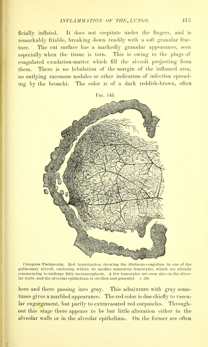 ficially inflated. It does not crepitate under the fingers, and is remarkably friable, breaking down readily with a soft granular frac- ture. The cut surface has a markedly granular appearance, seen especially w^hen the tissue is torn. This is owing to the plugs of coagulated exudation-matter which fill the alveoli projecting from them. There is no lobulation of the margin of the inflamed area, no outlying racemose nodules or other indication of infection spread- ing by the bronchi. The color is of a dark reddish-brown, often Fig. 145. Croupous Pneumonia. Red hepatization, showing the fibrinous coagulum in one of the pulmonary alveoli, enclosing within its meshes numerous leucocytes, which are already commencing to undergo fatty metamorphosis. A few leucocytes are seen also on the alveo- lar walls, and- the alveolar epithelium is swollen and granular. X 200. here and there passing into gray. This admixture Avith gray some- times gives a marbled appearance. The red color is due chiefly to vascu- lar engorgement, but partly to extravasated red corpuscles. Through- out this stage there appears to be but little alteration either in the alveolar walls or in the alveolar epithelium. On the former are often