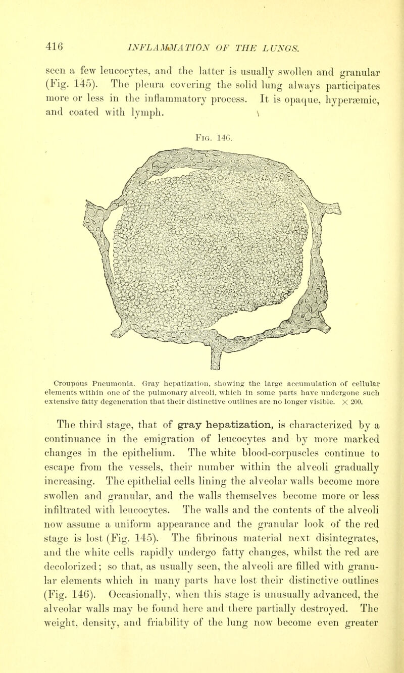 seen a few leucocytes, and the latter is usually swollen and granular (Fig. 145). The pleura covering the solid lung always participates more or less in the inflammatory process. It is opaque, hyperaimic, and coated with lymph. Croupous Pneumonia. Gray hepatization, showing the large accumulation of cellular elements within one of the pulmonary alveoli, which in some parts have undergone such extensive fatty degeneration that their distinctive outlines are no longer visible. X 200. The third stage, that of gray hepatization, is characterized by a continuance in the emigration of leucocytes and by more marked changes in the epithelium. The white blood-corpuscles continue to escape from the vessels, their number within the alveoli gradually increasing. The epithelial cells lining the alveolar walls become more swollen and granular, and the walls themselves become more or less infiltrated with leucocytes. The walls and the contents of the alveoli now assume a uniform appearance and the granular look of the red stage is lost (Fig. 145). The fibrinous material next disintegrates, and the white cells rapidly undergo fatty changes, whilst the red are decolorized; so that, as usually seen, the alveoli are filled with granu- lar elements which in many parts have lost their distinctive outlines (Fig. 146). Occasionally, when this stage is unusually advanced, the alveolar walls may be found here and there partially destroyed. The weight, density, and friability of the lung now become even greater