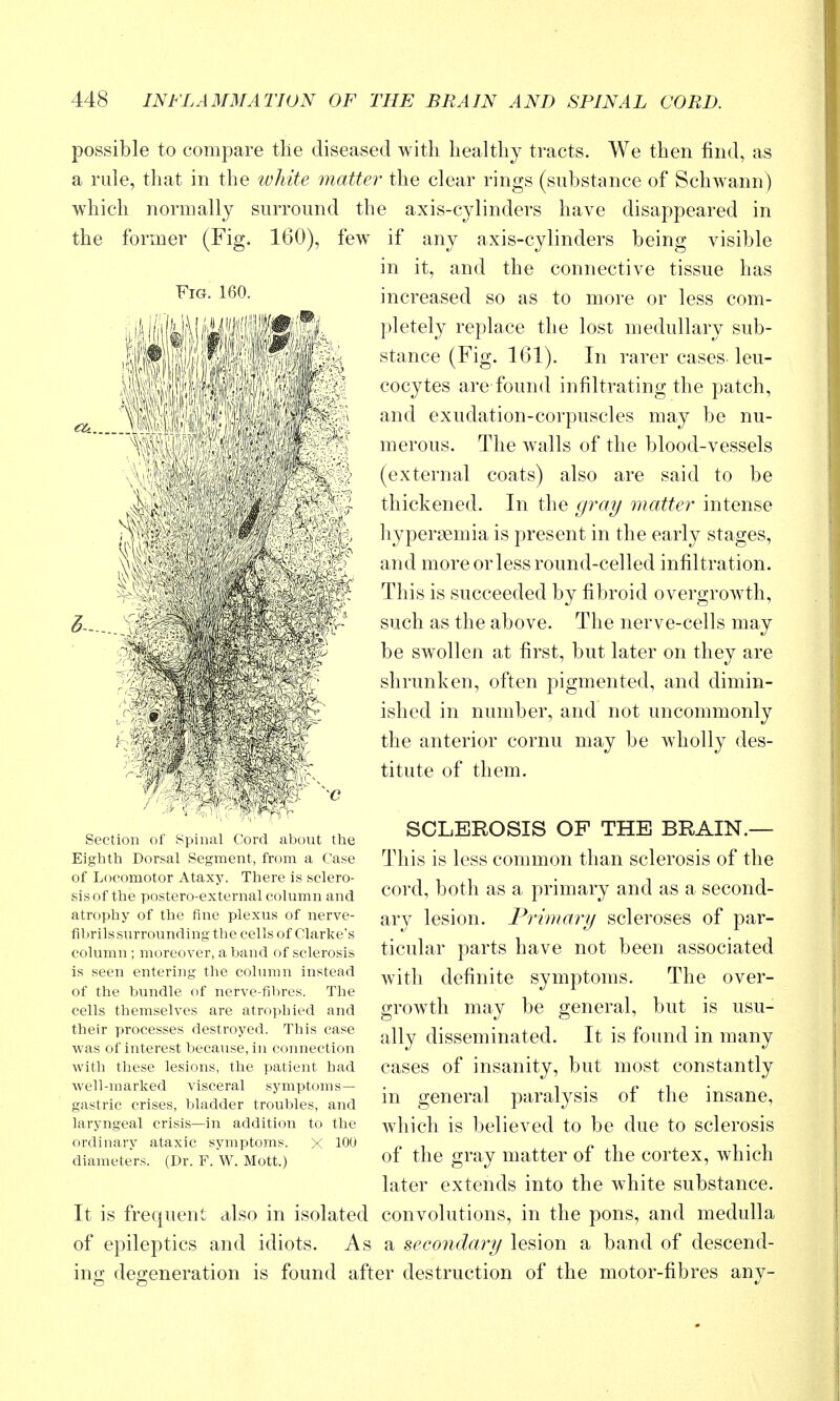 possible to compare the diseased with healthy tracts. We then find, as a rule, that in the white ^natter the clear rings (substance of Schwann) which normally surround the axis-cylinders have disappeared in the former (Fig. 160), few if any axis-cylinders being visible in it, and the connective tissue has increased so as to more or less com- pletely replace the lost medullary sub- stance (Fig. 161). In rarer cases-leu- cocytes are found infiltrating the patch, and exudation-corpuscles may be nu- merous. The walls of the blood-vessels (external coats) also are said to be thickened. In the g7r(7/ matter intense hypersemia is present in the early stages, and more or less round-celled infiltration. This is succeeded by fibroid overgrow^th, such as the above. The nerve-cells may be swollen at first, but later on they are shrunken, often pigmented, and dimin- ished in number, and not uncommonly the anterior cornu may be wholly des- titute of them. Section of Spinal Cord about the Eighth Dorsal Segment, from a Case of Locomotor Ataxy. There is sclero- sis of the postero-external column and atrophy of the fine plexus of nerve- fibrils surrounding the cells of Clarke's column ; moreover, a band of sclerosis is seen entering the column instead of the bundle of nerve-fibres. The cells themselves are atrophied and their processes destroyed. This case was of interest because, in connection v^ith these lesions, the patient had well-marked visceral symptoms- gastric crises, bladder troubles, and laryngeal crisis—in addition to the ordinary ataxic symptoms. x 100 diameters. (Dr. F. W. Mott.) It is frequent also in isolated of epileptics and idiots. As SCLEROSIS OF THE BRAIN.— This is less common than sclerosis of the cord, both as a primary and as a second- ary lesion. P7nma7'y scleroses of par- ticular parts have not been associated w^ith definite symptoms. The over- growth may be general, but is usu- ally disseminated. It is found in many cases of insanity, but most constantly in general paralysis of the insane, Avhich is believed to be due to sclerosis of the gray matter of the cortex, which later extends into the white substance, convolutions, in the pons, and medulla a secondary lesion a band of descend- ing degeneration is found after destruction of the motor-fibres any-
