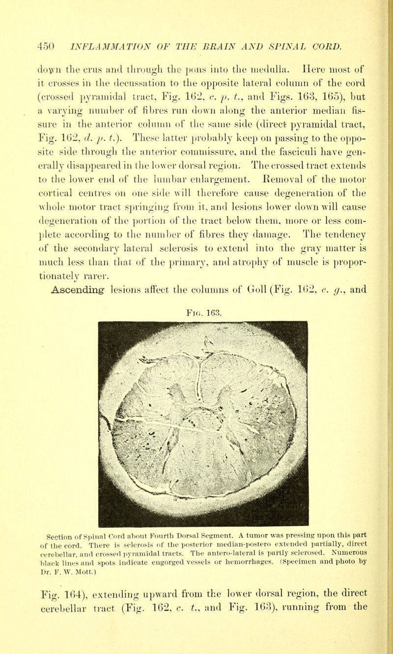 do\vn the crus and tlirougli the ptsns into the medulla. Here most of it crosses in the decussation to the opposite lateral column of the cord (crossed pyramidal tract, Fig. 162, c. p. t., and Figs. 163, 165), but a varying number of fibres run down along the anterior median fis- sure in the anterior column of tlie same side (direct pyramidal tract, Fig. 162, d. p. t.). These latter probably keep on passing to the oppo- site side throuo-h the anterior commissure, and the fasciculi have o-en- erally disappeared in tlie lower dorsal region. The crossed tract extends to the lower end of the lumbar enlargement. Removal of the motor cortical centres on one side will therefore cause degeneration of the whole motor tract springing from it, and lesions lower dow n Avill cause degeneration of the portion of the tract below^ them, more or less com- plete according to the number of fibres they damage. The tendency of the secondary lateral sclerosis to extend into the gray matter is much less than that of the primary, and atro})hy of muscle is propor- tionately rarer. Ascending' lesions affect the columns of Goll (Fig. 162, c. g., and Fk;. ir)?>. Section of Spinal Cord about Fourth Dorsal Segment. A tumor was pressing upon this part of the cord. There is sclerosis of the posterior median-postero extended partially, direct cerebellar, and crossed pyramidal tracts. The antero-lateral is partly sclerosed. Numerous black lines and spots indicate engorged vessels or hemorrhages. (Specimen and photo by Dr. F. W. Mott.) Fig. 164), extending upAvard from the lower dorsal region, the direct cerebellar tract (Fig. 162, c. f., and Fig. 163), running from the