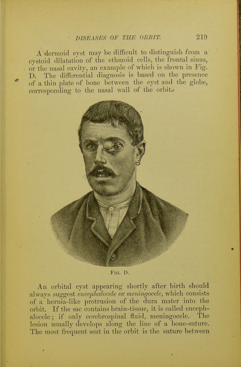 A dermoid cyst may be difficult to distinguish from a cystoid dilatation of the ethmoid cells, the frontal sinus, or the nasal cavity, an ex-ample of which is shown in Fig. D. The differential diagnosis is based on the presence of a thin plate of hone between the cyst and the globe, corresponding to the nasal wall of the orbit.* Fig. d. An orbital cyst appearing shortly after birth should always suggest encephalocele or meningocele, which consists of a hernia-like protrusion of the dura mater into the orbit. If the sac contains brain-tissue, it is called enceph- alocele; if only cerebrospinal fluid, meningocele. The lesion usually develops along the line of a bone-suture. The most frequent seat in the orbit is the suture between