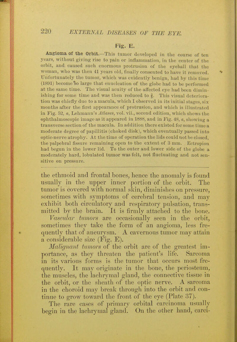 Fig. E. Angioma of the Orbit.— This tumor developed in the course of ten years, without giving rise to pain or inflammation, in the center of the orbit, and caused such enormous protrusion of the eyeball that the woman, who was then 41 years old, finally consented to have it removed. Unfortunately the tumor, which was evidently benign, had by this time (1891) become^o large that enucleation of the globe had to be performed at the same time. The visual acuity of the affected eye had been dimin- ishing for some time and was then reduced to §. This visual deteriora- tion was chiefly due to a macula, which I observed in its initial stages, six months after the first appearance of protrusion, and which is illustrated in Fig. 52, a, Lehmanu's Atlases, vol. vii., second edition, which shows the ophthalmoscopic image as it appeared in 1888, and in Fig. 48, a, showing a transverse, section of the macula. In addition there existed for some t inn a moderate degree of papillitis (choked disk), which eventually passed into optic-nerve atrophy. At the time of operation the lids could not he closed, the palpebral fissure remaining open to the extent of '.i mm. Ectropion had begun in the lower lid. To the outer and lower side of the globe a moderately hard, lobulated tumor was felt, not fluctuating and not sen- sitive on pressure. the ethmoid and frontal bones, hence the anomaly is found usually in the upper inner portion of the orbit. The tumor is covered with normal skin, diminishes on pressure, sometimes with symptoms of cerebral tension, and may exhibit both circulatory and respiratory pulsation, trans- mitted by the brain. It is firmly attached to the bone. Vascular tumors are occasionally seen in the orbit, sometimes they take the form of an angioma, less fre- quently that of aneurysm. A cavernous tumor may attain a considerable size (Fig. E). Malignant tumors of the orbit are of the greatest im- portance, as they threaten the patient's life. Sarcoma in its various forms is the tumor that occurs most fre- quently. It may originate in the bone, the periosteum, the muscles, the lachrymal gland, the connective tissue in the orbit, or the sheath of the optic nerve. A sarcoma in the choroid may break through into the orbit and con- tinue to grow toward the front of the eye (Plate 37). The rare cases of primary orbital carcinoma usually begin in the lachrymal gland. On the other hand, carci-