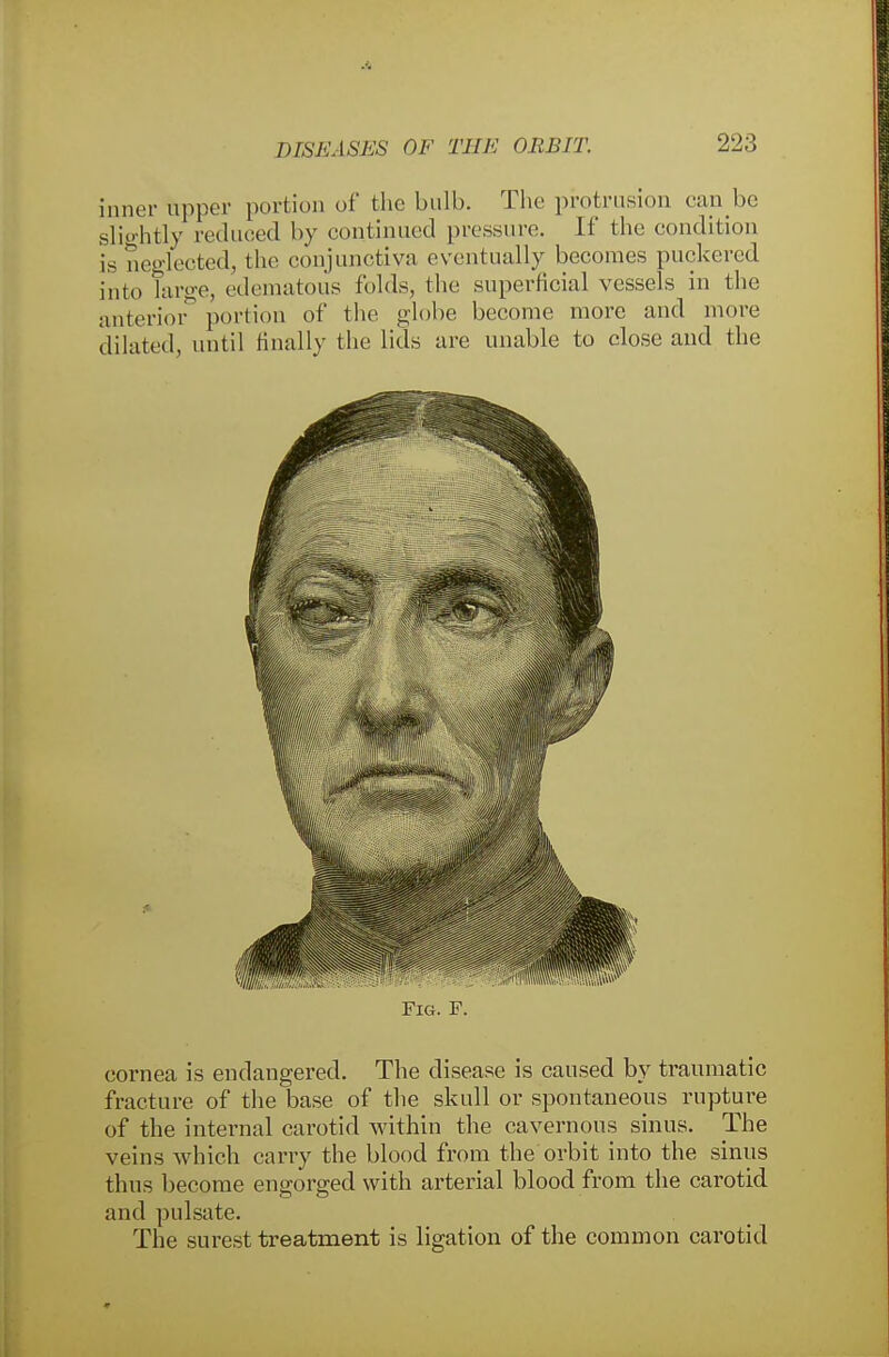 inner tipper portion of the bulb. The protrusion can be slightly reduced by continued pressure. If the condition is neglected, the conjunctiva eventually becomes puckered into large, edematous folds, the superficial vessels in the anterior portion of the globe become more and more dilated, until finally the lids are unable to close and the Fig. F. cornea is endangered. The disease is caused by traumatic fracture of the base of the skull or spontaneous rupture of the internal carotid within the cavernous sinus. The veins which cany the blood from the orbit into the sinus thus become engorged with arterial blood from the carotid and pulsate. The surest treatment is ligation of the common carotid
