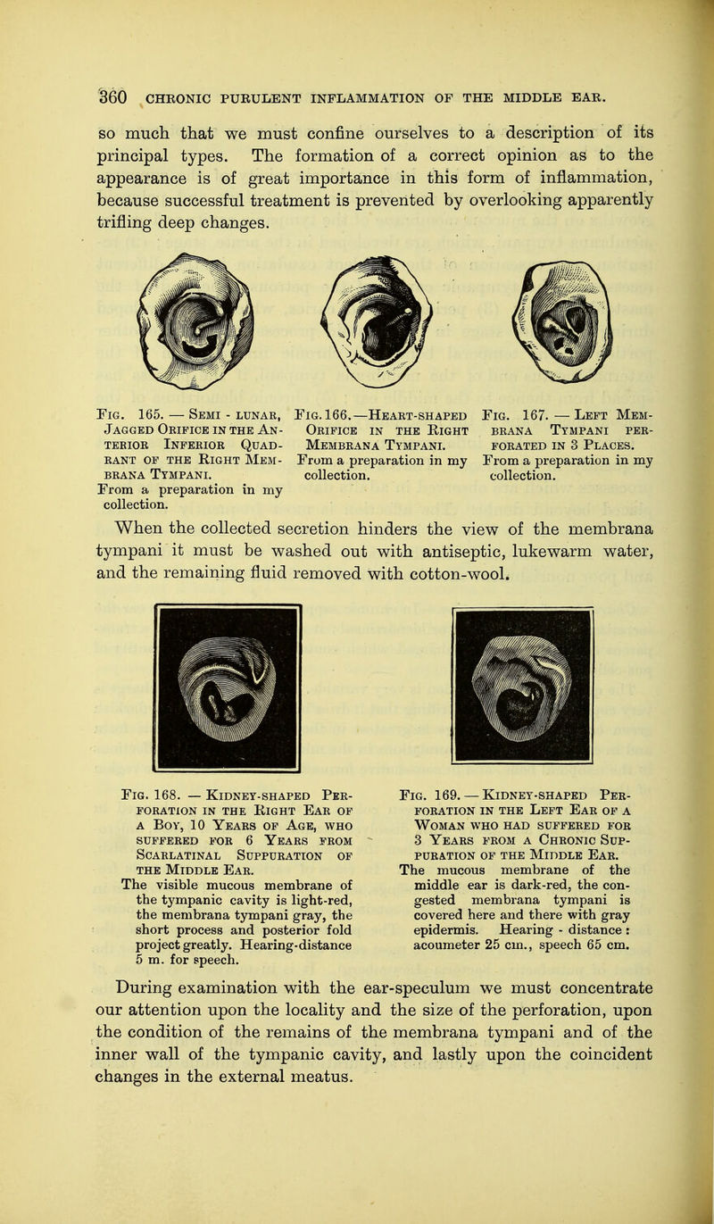 so much that we must confine ourselves to a description of its principal types. The formation of a correct opinion as to the appearance is of great importance in this form of inflammation, because successful treatment is prevented by overlooking apparently trifling deep changes. Fig. 166.—Heart-shaped Oeifice in the Right Membrana Tympani. From a preparation in my collection. Fig. 167. — Left Mem- brana Tympani per- forated in 3 Places. From a preparation in my collection. Fig. 165. — Semi - lunar, Jagged Orifice in the An- terior Inferior Quad- rant of the Right Mem- brana Tympani. From a preparation in my collection. When the collected secretion hinders the view of the membrana tympani it must be washed out with antiseptic, lukewarm water, and the remaining fluid removed with cotton-wool. Fig. 168. — Kidney-shaped Per- foration in the Right Ear of a Boy, 10 Years of Age, who suffered for 6 Years from Scarlatinal Suppuration of the Middle Ear. The visible mucous membrane of the t37mpanic cavity is light-red, the membrana tympani gray, the short process and posterior fold project greatly. Hearing-distance 5 m. for speech. Fig. 169. — Kidney-shaped Per- foration in the Left Ear of a Woman who had suffered for 3 Years from a Chronic Sup- puration of the Middle Ear. The mucous membrane of the middle ear is dark-red, the con- gested membrana tympani is covered here and there with gray epidermis. Hearing - distance : acoumeter 25 cm., speech 65 cm. During examination with the ear-speculum we must concentrate our attention upon the locality and the size of the perforation, upon the condition of the remains of the membrana tympani and of the inner wall of the tympanic cavity, and lastly upon the coincident changes in the external meatus.