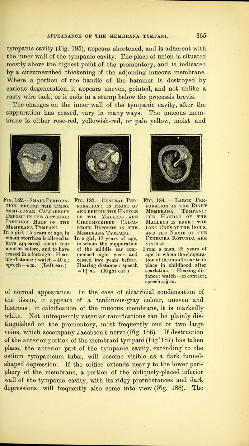 tympanic cavity (Fig. 185), appears shortened, and is adherent with the inner wall of the tympanic cavity. The place of union is situated mostly above the highest point of the promontory, and is indicated by a circumscribed thickening of the adjoining mucous membrane. Where a portion of the handle of the hammer is destroyed by carious degeneration, it appears uneven, pointed, and not unlike a rusty wire tack, or it ends in a stump below the processis brevis. The changes on the inner wall of the tympanic cavity, after the suppuration has ceased, vary in many ways. The mucous mem- brane is either rose-red, yellowish-red, or pale yellow, moist and Fig. 182.—Small Perfora- tion BEHIND THE UMBO. Semi-lunar Calcareous Deposit in the Anterior Inferior Half of the Membrana Tympani. In a girl, 15 years of age, in whom otorrhoea is alleged to have appeared about four months before, and to have ceased in a fortnight. Hear- ing-distance : watch = 40 c; speech = 4 m. (Left ear.) Fig. 183.—Central Per- foration ; in front of and behind the handle of the Malleus are Circumscribed Calca- reous Deposits in the Membrana Tympani. In a girl, 17 years of age, in whom the suppuration of the middle ear com- menced eight years and ceased two years before. Hearing-distance : speech = 1| m. (Right ear.) Fig. 184. — Large Per- foration in the Eight Membrana Tympani ; the Handle of the Malleus is free ; the. long crus of the incus, and the Niche of the Fenestra Rotunda are. visible. From a man, 28 years of age, in whom the suppura- tion of the middle ear took place in childhood after scarlatina. Hearing-dis- tance : watch — in contact speech = ^ m. of normal appearance. In the case of cicatricial condensation of the tissue, it appears of a tendinous-gray colour, uneven and lustrous ; in calcification of the mucous membrane, it is markedly white. Not unfrequently vascular ramifications can be plainly dis- tinguished on the promontory, most frequently one or two large veins, which accompany Jacobson's nerve (Fig. 186). If destruction of the anterior portion of the membrani tympani (Fig.:187) has taken place, the anterior part of the tympanic cavity, extending to the ostium tympanicum tubse, will become visible as a dark funnel- shaped depression. If the orifice extends nearly to the lower peri- phery of the membrane, a portion of the obliquely-placed inferior wall of the tympanic cavity, with its ridgy protuberances and dark depressions, will frequently also come into view (Fig. 188). The