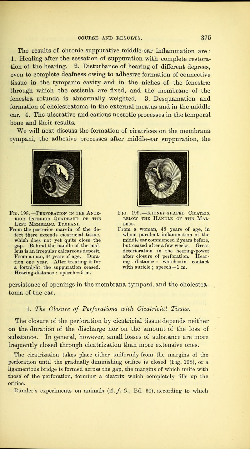 The results of chronic suppurative middle-ear inflammation are : 1. Healing after the cessation of suppuration with complete restora- tion of the hearing. 2. Disturbance of hearing of different degrees, even to complete deafness owing to adhesive formation of connective tissue in the tympanic cavity and in the niches of the fenestrse through which the ossicula are fixed, and the membrane of the fenestra rotunda is abnormally weighted. 3. Desquamation and formation of cholesteatoma in the external meatus and in the middle ear. 4. The ulcerative and carious necrotic processes in the temporal bone and their results. We will next discuss the formation of cicatrices on the membrana tympani, the adhesive processes after middle-ear suppuration, the Fig. 198.—Perforation in the Ante- rior Inferior Quadrant of the Left Membrana Tympani. From the posterior margin of the de- fect there extends cicatricial tissue, which does not yet quite close the gap. Behind the handle of the mal- leus is an irregular calcareous deposit. From a man, 64 years of age. Dura- tion one year. After treating it for a fortnight the suppuration ceased. Hearing-distance : speech = 5 m. Fig. 199.—Kidney-shaped Cicatrix below the handle of the mal- LEUS. From a woman, 48 years of age, in whom purulent inflammation of the middle ear commenced 2 years before, but ceased after a few weeks. Great deterioration in the hearing-power after closure of perforation. Hear- ing - distance : watch = in contact with auricle ; speech = 1 m. persistence of openings in the membrana tympani. and the cholestea- toma of the ear. 1. The Closure of Perforations with Cicatricial Tissue. The closure of the perforation by cicatricial tissue depends neither on the duration of the discharge nor on the amount of the loss of substance. In general, however, small losses of substance are more frequently closed through cicatrization than more extensive ones. The cicatrization takes place either uniformly from the margins of the perforation until the gradually diminishing orifice is closed (Fig. 198), or a ligamentous bridge is formed across the gap, the margins of which unite with those of the perforation, forming a cicatrix which completely fills up the orifice. Kumler's experiments on animals (A. f. 0., Bd. 30), according to which