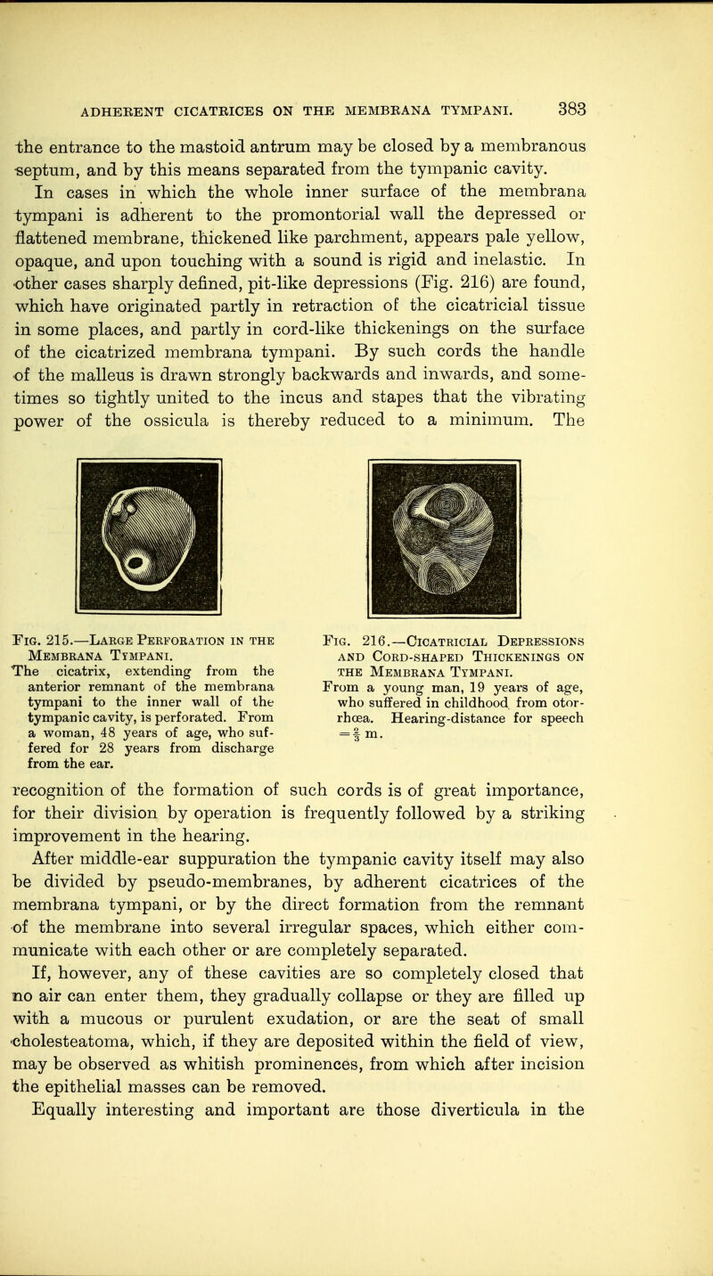 the entrance to the mastoid antrum may be closed by a membranous •septum, and by this means separated from the tympanic cavity. In cases in which the whole inner surface of the membrana tympani is adherent to the promontorial wall the depressed or flattened membrane, thickened like parchment, appears pale yellow, opaque, and upon touching with a sound is rigid and inelastic. In other cases sharply defined, pit-like depressions (Fig. 216) are found, which have originated partly in retraction of the cicatricial tissue in some places, and partly in cord-like thickenings on the surface of the cicatrized membrana tympani. By such cords the handle of the malleus is drawn strongly backwards and inwards, and some- times so tightly united to the incus and stapes that the vibrating power of the ossicula is thereby reduced to a minimum. The Fig. 215.—Large Perforation in the Membrana Timpani. The cicatrix, extending from the anterior remnant of the membrana tympani to the inner wall of the tympanic cavity, is perforated. From a woman, 48 years of age, who suf- fered for 28 years from discharge from the ear. Fig. 216.—Cicatricial Depressions and Cord-shaped Thickenings on the Membrana Tympani. From a young man, 19 years of age, who suffered in childhood from otor- rhcea. Hearing-distance for speech = | m. recognition of the formation of such cords is of great importance, for their division by operation is frequently followed by a striking improvement in the hearing. After middle-ear suppuration the tympanic cavity itself may also be divided by pseudo-membranes, by adherent cicatrices of the membrana tympani, or by the direct formation from the remnant of the membrane into several irregular spaces, which either com- municate with each other or are completely separated. If, however, any of these cavities are so completely closed that no air can enter them, they gradually collapse or they are filled up with a mucous or purulent exudation, or are the seat of small ■cholesteatoma, which, if they are deposited within the field of view, may be observed as whitish prominences, from which after incision the epithelial masses can be removed. Equally interesting and important are those diverticula in the