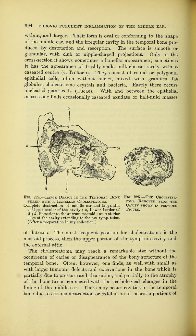 walnut, and larger. Their form is oval or conforming to the shape of the middle ear, and the irregular cavity in the temporal bone pro- duced by destruction and resorption. The surface is smooth or glandular, with club or nipple-shaped projections. Only in the cross-section it shows sometimes a lamellar appearance; sometimes it has the appearance of freshly-made milk-cheese, rarely with a caseated centre (v. Tröltsch). They consist of round or polygonal epithelial cells, often without nuclei, mixed with granules, fat globules, cholestearine crystals and bacteria. Earely there occurs nucleated giant cells (Lucae). With and between the epithelial masses one finds occasionally caseated exudate or half-fluid masses w u Fig. 224.—Large Defect in the Temporal Bone filled with a lamellar cholesteatoma. Complete destruction of middle ear and labyrinth. o, Upper border of the cavity ; u, Lower border of it ; h, Posterior to the antrum mastoid ; os, Anterior edge of the cavity extending to the ost. tymp. tubse. (After a preparation in my collection.) Fig. 225.—The Cholestea- toma Removed from the Cavity shown in previous Figure. of detritus. The most frequent position for cholesteatoma is the mastoid process, then the upper portion of the tympanic cavity and the external attic. The cholesteatoma may reach a remarkable size without the occurrence of caries or disappearance of the bony structure of the temporal bone. Often, however, one finds, as well with small as with larger tumours, defects and excavations in the bone which is partially due to pressure and absorption, and partially to the atrophy of the bone-tissue connected with the pathological changes in the lining of the middle ear. There may occur cavities in the temporal bone due to carious destruction or exfoliation of necrotic portions of