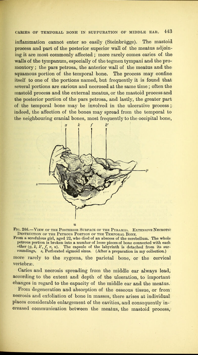 inflammation cannot enter so easily (Steinbrügge). The mastoid process and part of the posterior superior wall of the meatus adjoin- ing it are most commonly affected ; more rarely comes caries of the walls of the tympanum, especially of the tegmen tympani and the pro- montory ; the pars petrosa, the anterior wall of the meatus and the squamous portion of the temporal bone. The process may confine itself to one of the portions named, but frequently it is found that several portions are carious and necrosed at the same time ; often the mastoid process and the external meatus, or the mastoid process and the posterior portion of the pars petrosa, and lastly, the greater part of the temporal bone may be involved in the ulcerative process ; indeed, the affection of the bones may spread from the temporal to the neighbouring cranial bones, most frequently to the occipital bone, (J Jc f kf s u Fig. 246.—View of the Posterior Surface of the Pyramid. Extensive Necrotic Destruction of the Petrous Portion of the Temporal Bone. From a scrofulous girl, aged 22, who died of an abscess of the cerebellum. The whole petrous portion is broken into a number of loose pieces of bone connected with each other (<7, k, h',f, v, u). The capsule of the labyrinth is detached from its sur- roundings, s, Perforated sigmoid sinus. (After a preparation in my collection.) more rarely to the zygoma, the parietal bone, or the cervical vertebrae. Caries and necrosis spreading from the middle ear always lead, according to the extent and depth of the ulceration, to important changes in regard to the capacity of the middle ear and the meatus. From degeneration and absorption of the osseous tissue, or from necrosis and exfoliation of bone in masses, there arises at individual places considerable enlargement of the cavities, and consequently in- creased communication between the meatus, the mastoid process,