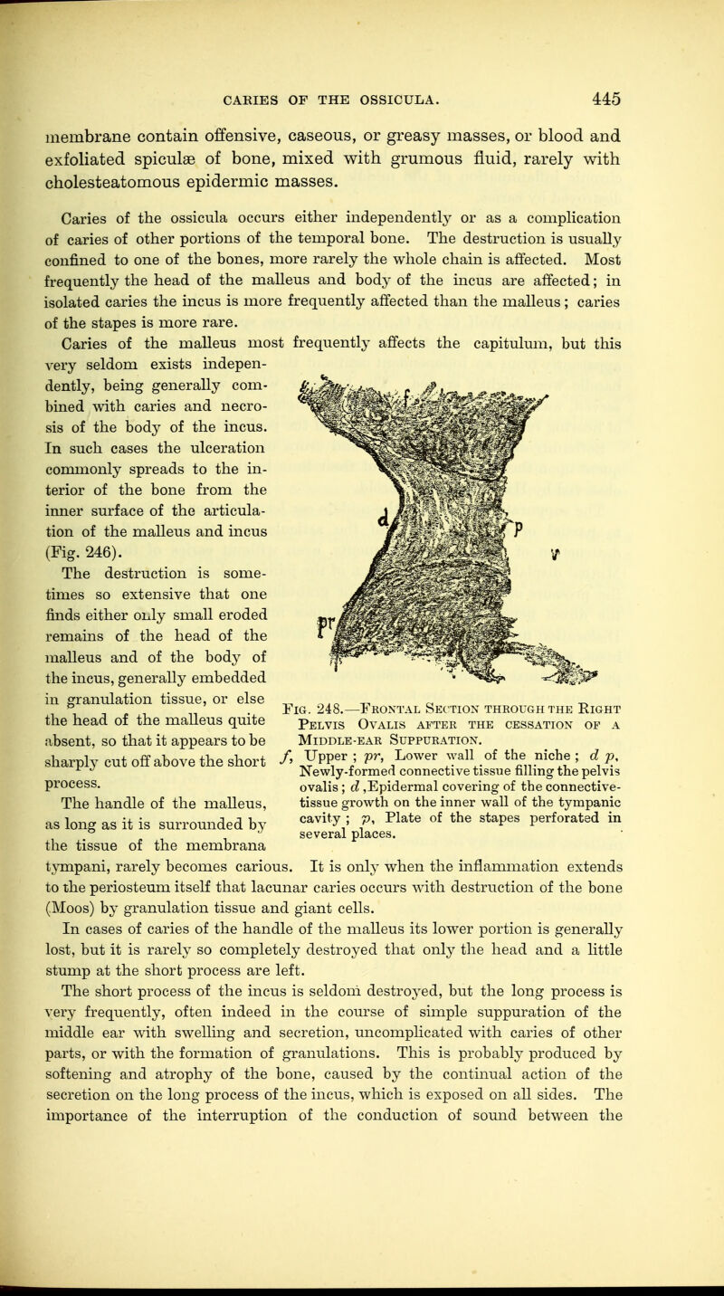membrane contain offensive, caseous, or greasy masses, or blood and exfoliated spiculae of bone, mixed with grumous fluid, rarely with cholesteatomous epidermic masses. Caries of the ossicula occurs either independently or as a complication of caries of other portions of the temporal bone. The destruction is usually confined to one of the bones, more rarely the whole chain is affected. Most frequently the head of the malleus and bodj- of the incus are affected; in isolated caries the incus is more frequently affected than the malleus; caries of the stapes is more rare. Caries of the malleus most frequently affects the capitulum, but this very seldom exists indepen- dently, being generally com- bined with caries and necro- sis of the hody of the incus. In such cases the ulceration commonly spreads to the in- terior of the bone from the inner surface of the articula- tion of the malleus and incus (Fig. 246). The destruction is some- times so extensive that one finds either only small eroded remains of the head of the malleus and of the body of the incus, generally embedded in granulation tissue, or else the head of the malleus quite absent, so that it appears to be sharply cut off above the short process. The handle of the malleus, as long as it is surrounded by the tissue of the membrana tympani, rarely becomes carious. It is only when the inflammation extends to the periosteum itself that lacunar caries occurs with destruction of the bone (Moos) by granulation tissue and giant cells. In cases of caries of the handle of the malleus its lower portion is generally lost, but it is rarely so completely destroyed that only the head and a little stump at the short process are left. The short process of the incus is seldom destroyed, but the long process is very frequently, often indeed in the course of simple suppuration of the middle ear with swelling and secretion, uncomplicated with caries of other parts, or with the formation of granulations. This is probably produced by softening and atrophy of the bone, caused by the continual action of the secretion on the long process of the incus, which is exposed on all sides. The importance of the interruption of the conduction of sound between the Fig. 248.—Frontal Section through the Right Pelvis Ovalis after the cessation of a Middle-ear Suppuration. /, Upper ; pr, Lower wall of the niche ; d p, Newly-formed connective tissue filling the pelvis ovalis; d,Epidermal covering of the connective- tissue growth on the inner wall of the tympanic cavity ; p, Plate of the stapes perforated in several places.