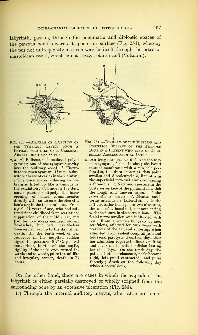 labyrinth, passing through the pneumatic and diploetic spaces of the petrous bone towards its posterior surface (Fig. 254), whereby the pus not unfrequently makes a way for itself through the petroso- mastoidean canal, which is not always obliterated (Voltolini). Pig. 253.—Diagram of a Section of the Tympanic Cavity from a Patient who died of a Cerebral Abscess due to an Otitis. a, a', a, Bulbous, pedunculated polypi growing out of the tympanic cavity into the auditory canal ; b, Fissure in the tegmen tyrapani, 1 \ mm. in size, without trace of caries in the vicinity; c, The dura mater adhering to the brain is lifted up like a tumour by the exudation ; d, Sinus in the dura mater passing obliquely, the inner opening of which communicates directly with an abscess the size of a hen's egg in the temporal lobe. Prom a girl, 21 years of age, who had suf- fered since childhood from scarlatinal suppuration of the middle ear, and had for five weeks endured violent headaches, but had nevertheless been on her feet up to the day of her death. In the tenth week of her residence in the hospital, sudden rigoms, temperature 40*2° C,general convulsions, inertia of the pupils, rigidity of the neck, eyes turned in- wards and upwards, pulse thread-like and irregular, stupor, death in 1\ hours. Fig. 254.—Diagram of the Superior and Posterior Surface of the Petrous Bone in a Patient who died of Cere- bellar Abscess from an Otitis. a, An irregular osseous defect in the teg- men tympani, 5 mm. in size ; the bared mucous membrane with a pin-hole per- foration, the dura mater at that point swollen and discoloured ; b, Fenestra in the superficial petrosal sinus containing a thrombus ; c, Necrosed aperture in the posterior surface of the pyramid in which the rough and uneven capsule of the labyrinth is visible; d, Meatus audi- torius internus ; e, Lateral sinus. In the left cerebellar hemisphere two abscesses, the size of a hazel-nut, communicating with the fissure in the petrous bone. The facial nerve swollen and infiltrated with pus. From a woman 36 years of age, scrofulous, affected for two years with otorrhcea of the ear, and suffering, when admitted, from violent occipital pain and left facial paralysis. Fourteen days after her admission repeated bilious vomiting and fever set in, this condition lasting for nine days. On the tenth day the patient lost consciousness, neck became rigid, left pupil contracted, and pulse thready ; death on the following day without convulsions. On the other hand, there are cases in which the capsule of the labyrinth is either partially destroyed or wholly stripped from the surrounding bone by an extensive ulceration (Fig. 254). (c) Through the internal auditory meatus, when after erosion of