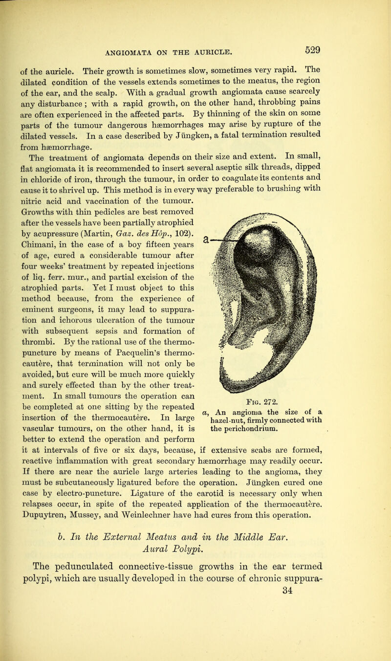 ANGIOMATA ON THE AUBICLE. of the auricle. Their growth is sometimes slow, sometimes very rapid. The dilated condition of the vessels extends sometimes to the meatus, the region of the ear, and the scalp. With a gradual growth angiomata cause scarcely any disturbance ; with a rapid growth, on the other hand, throbbing pains are often experienced in the affected parts. By thinning of the skin on some parts of the tumour dangerous haemorrhages may arise by rupture of the dilated vessels. In a case described by Jüngken, a fatal termination resulted from haemorrhage. The treatment of angiomata depends on their size and extent. In small, flat angiomata it is recommended to insert several aseptic silk threads, dipped in chloride of iron, through the tumour, in order to coagulate its contents and cause it to shrivel up. This method is in everyway preferable to brushing with nitric acid and vaccination of the tumour. Growths with thin pedicles are best removed after the vessels have been partially atrophied by acupressure (Martin, Gaz. des Hop., 102). Chimani, in the case of a boy fifteen years of age, cured a considerable tumour after four weeks' treatment by repeated injections of liq. ferr. mur., and partial excision of the atrophied parts. Yet I must object to this method because, from the experience of eminent surgeons, it may lead to suppura- tion and ichorous ulceration of the tumour with subsequent sepsis and formation of thrombi. By the rational use of the thermo- puncture by means of Pacquelin's thermo- cautere, that termination will not only be avoided, but cure will be much more quickly and surely effected than by the other treat- ment. In small tumours the operation can be completed at one sitting by the repeated insertion of the thermocautere. In large vascular tumours, on the other hand, it is better to extend the operation and perform it at intervals of five or six days, because, if extensive scabs are formed, reactive inflammation with great secondary haemorrhage may readily occur. If there are near the auricle large arteries leading to the angioma, they must be subcutaneously ligatured before the operation. Jüngken cured one case by electro-puncture. Ligature of the carotid is necessary only when relapses occur, in spite of the repeated application of the thermocautere. Dupuytren, Mussey, and Weinlechner have had cures from this operation. Fig. 272. An angioma the size of a. hazel-nut, firmly connected with the perichondrium. b. In the External Meatus and in the Middle Ear. Aural Polypi. The pedunculated connective-tissue growths in the ear termed polypi, which are usually developed in the course of chronic suppura- 34