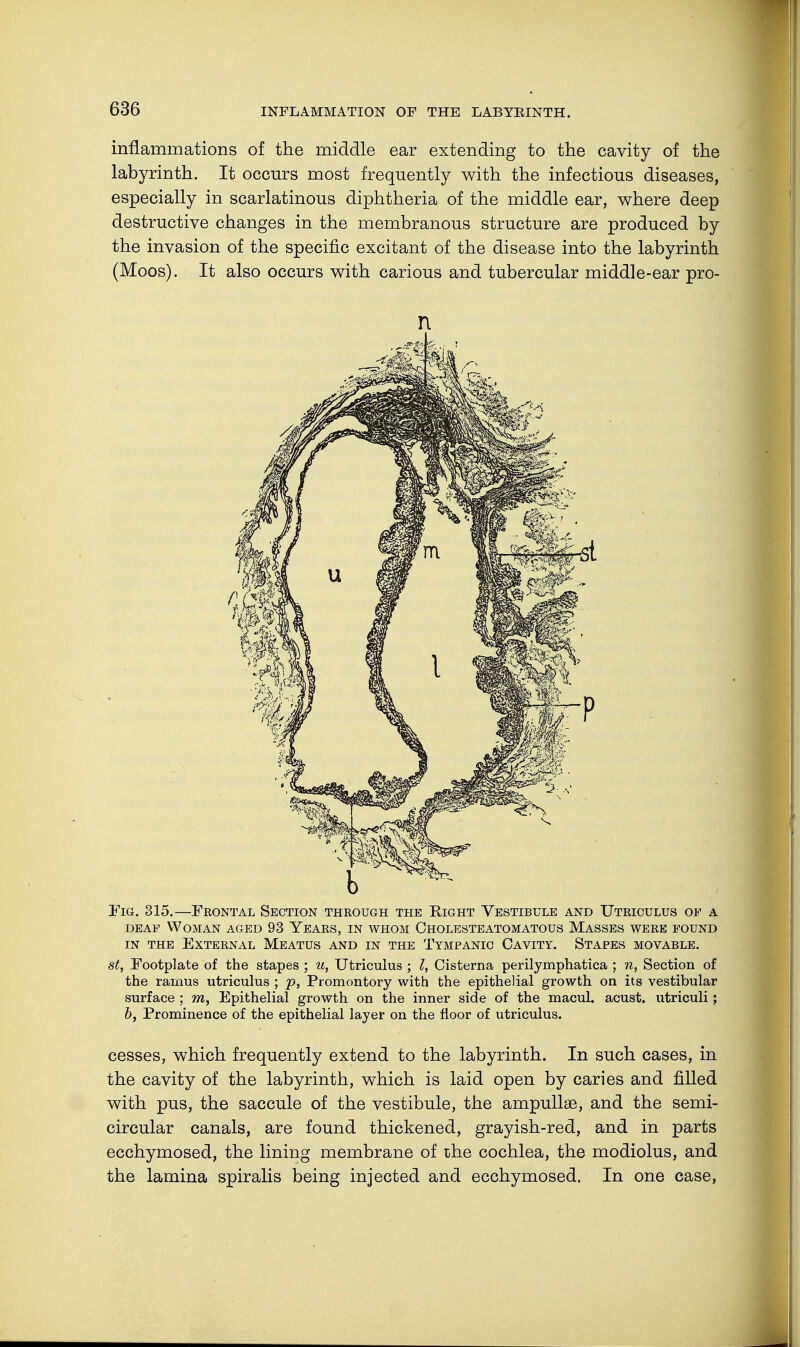 inflammations of the middle ear extending to the cavity of the labyrinth. It occurs most frequently with the infectious diseases, especially in scarlatinous diphtheria of the middle ear, where deep destructive changes in the membranous structure are produced by the invasion of the specific excitant of the disease into the labyrinth (Moos). It also occurs with carious and tubercular middle-ear pro- lyl Fig. 315.—Feontal Section through the Right Vestibule and Uteiculus of a deaf Woman aged 93 Yeaes, in whom Cholesteatomatous Masses weee found in the exteenal meatus and in the tympanic cavity. stapes movable. st, Footplate of the stapes ; u, Utriculus ; I, Cisterna perilymphatica ; n, Section of the ramus utriculus ; p, Promontory with the epithelial growth on its vestibular surface ; m, Epithelial growth on the inner side of the macul. acust. utriculi; b, Prominence of the epithelial layer on the floor of utriculus. cesses, which frequently extend to the labyrinth. In such cases, in the cavity of the labyrinth, which is laid open by caries and filled with pus, the saccule of the vestibule, the ampullae, and the semi- circular canals, are found thickened, grayish-red, and in parts ecchymosed, the lining membrane of the cochlea, the modiolus, and the lamina spiralis being injected and ecchymosed. In one case,