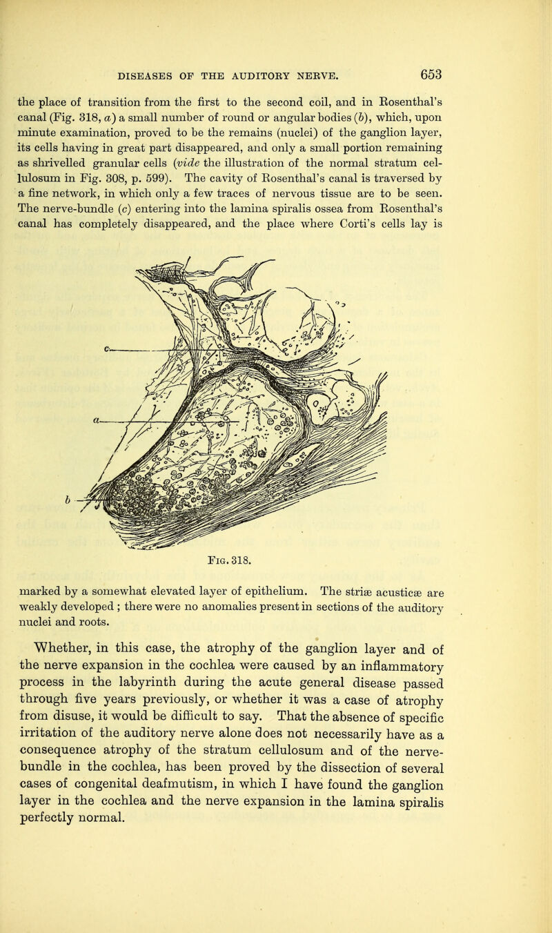 the place of transition from the first to the second coil, and in Eosenthal's canal (Fig. 318, a) a small number of round or angular bodies (&), which, upon minute examination, proved to be the remains (nuclei) of the ganglion layer, its cells having in great part disappeared, and only a small portion remaining as shrivelled granular cells (vide the illustration of the normal stratum cel- lulosum in Fig. 308, p. 599). The cavity of Eosenthal's canal is traversed by a fine network, in which only a few traces of nervous tissue are to be seen. The nerve-bundle (c) entering into the lamina spiralis ossea from Eosenthal's canal has completely disappeared, and the place where Corti's cells lay is Fig. 318. marked by a somewhat elevated layer of epithelium. The striae acusticge are weakly developed ; there were no anomalies present in sections of the auditory nuclei and roots. Whether, in this case, the atrophy of the ganglion layer and of the nerve expansion in the cochlea were caused by an inflammatory process in the labyrinth during the acute general disease passed through five years previously, or whether it was a case of atrophy from disuse, it would be difficult to say. That the absence of specific irritation of the auditory nerve alone does not necessarily have as a consequence atrophy of the stratum cellulosum and of the nerve- bundle in the cochlea, has been proved by the dissection of several cases of congenital deaf mutism, in which I have found the ganglion layer in the cochlea and the nerve expansion in the lamina spiralis perfectly normal.