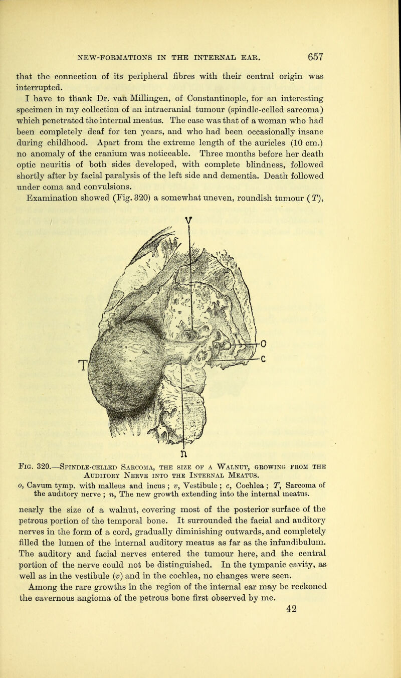 that the connection of its peripheral fibres with their central origin was interrupted. I have to thank Dr. van Millingen, of Constantinople, for an interesting specimen in my collection of an intracranial tumour (spindle-celled sarcoma) which penetrated the internal meatus. The case was that of a woman who had been completely deaf for ten years, and who had been occasionally insane during childhood. Apart from the extreme length of the auricles (10 cm.) no anomaly of the cranium was noticeable. Three months before her death optic neuritis of both sides developed, with complete blindness, followed shortly after by facial paralysis of the left side and dementia. Death followed under coma and convulsions. Examination showed (Fig. 320) a somewhat uneven, roundish tumour (T), V n Fig. 320.—Spindle-celled Sarcoma, the size of a Walnut, growing from the Auditory Nerve into the Internal Meatus. o, Oavum tymp. with malleus and incus ; v, Vestibule; c, Cochlea ; T, Sarcoma of the auditory nerve ; n, The new growth extending into the internal meatus. nearly the size of a walnut, covering most of the posterior surface of the petrous portion of the temporal bone. It surrounded the facial and auditory nerves in the form of a cord, gradually diminishing outwards, and completely filled the lumen of the internal auditory meatus as far as the infundibulum. The auditory and facial nerves entered the tumour here, and the central portion of the nerve could not be distinguished. In the tympanic cavity, as well as in the vestibule (v) and in the cochlea, no changes were seen. Among the rare growths in the region of the internal ear may be reckoned the cavernous angioma of the petrous bone first observed by me. 42