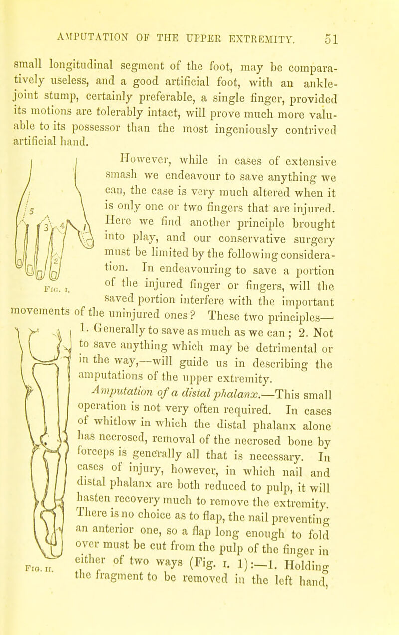 small longitudinal segment of the foot, may be compara- tively useless, and a good artificial foot, with an ankle- joint stump, certainly preferable, a single finger, provided its motions are tolerably intact, will prove much more valu- able to its possessor than the most ingeniously contrived artificial hand. However, while in cases of extensive smash we endeavour to save anything we can, the case is very much altered when it is only one or two fingers that are injured. Here we find another principle brought into play, and our conservative surgery must be limited by the following considera- tion. In endeavouring to save a portion *p«. r. of the injl,re<l finger or fingers, will the saved portion interfere with the important movements of the uninjured ones ? These two principles- 1. Generally to save as much as we can ; 2. Not to save anything which may be detrimental or in the way—will guide us in describing the amputations of the upper extremity. Amputation of a distal phalanx.—-This small operation is not very often required. In cases of whitlow in which the distal phalanx alone has necrosed, removal of the necrosed bone by forceps is generally all that is necessary. In cases of injury, however, in which nail and distal phalanx are both reduced to pulp, it will hasten recovery much to remove the extremity There is no choice as to flap, the nail preventing an anterior one, so a flap long enough to fold over must be cut from the pulp of the finger in either of two ways (Fig. i. Holding the fragment to be removed in the left hand Fio. ii.