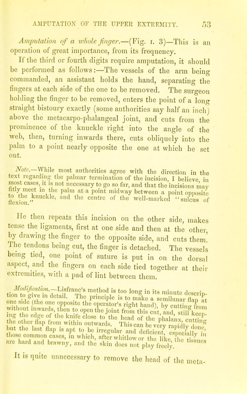 Amputation of a whole finger.—(Fig. r. 3)—This is an operation of great importance, from its frequency. If the third or fourth digits require amputation, it should be performed as follows:—The vessels of the arm being commanded, an assistant holds the hand, separating the fingers at each side of the one to be removed. The surgeon holding the finger to be removed, enters the point of a long straight bistoury exactly (some authorities say half an inch) above the metacarpophalangeal joint, and cuts from the prominence of the knuckle right into the angle of the web, then, turning inwards there, cuts obliquely into the palm to a point nearly opposite the one at which he set out. Note.—While most authorities agree with the direction in the text regarding the palmar termination of the incision, I believe in most case.s, it is not necessary to go so far, and that the incisions may fitly meet in the palm at a point midway between a point opposite to the knuckle, and the centre of the well-marked sulcus of flexion. He then repeats this incision on the other side, makes tense the ligaments, first at one side and then at the other, by drawing the finger to the opposite side, and cuts them' The tendons being cut, the finger is detached. The vessels being tied, one point of suture is put in on the dorsal aspect, and the fingers on each side tied together at their extremities, with a pad of lint between them. Modification.-Usfanc's method is too long in its minute descrin tion t„ give in detail. The principle is to mike a semilunar£ one side the one opposite the operator's right hand! bv cutti™ I Without inwards, then to open the joint from thS cut and stiH 1 mg the edge of the knife close to'the head of h,Cl an* i ^V' the other flap from within outwards. This can v TrSl S but the last flap is apt to be irregular Sfdfiffi SSuTft those common cases, in which, after whitlow or the like h, t 3 are hard and brawny, and the skin docs not play freely It is quite unnecessary to remove the head of the meta-