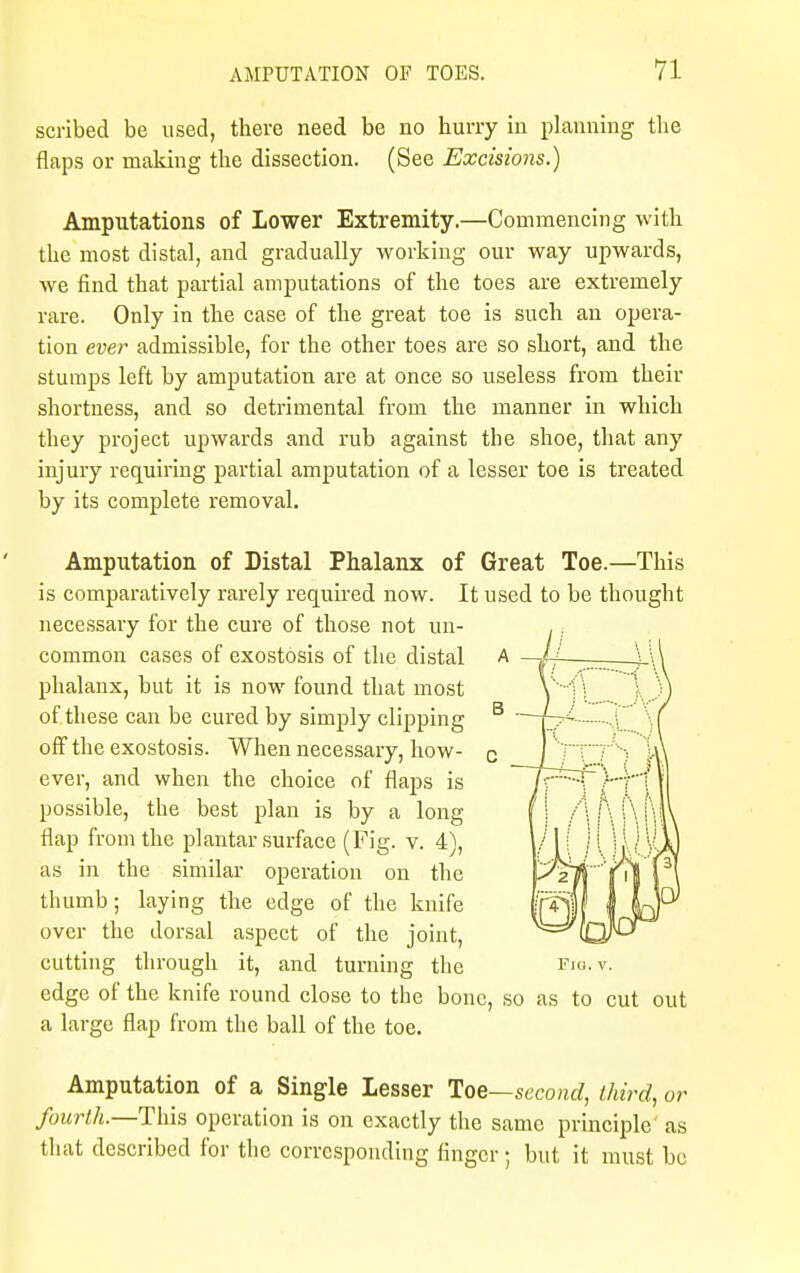 scribed be used, there need be no hurry in planning the flaps or making the dissection. (See Excisions.) Amputations of Lower Extremity.—Commencing with the most distal, and gradually working our way upwards, we find that partial amputations of the toes are extremely rare. Only in the case of the great toe is such an opera- tion ever admissible, for the other toes are so short, and the stumps left by amputation are at once so useless from their shortness, and so detrimental from the manner in which they project upwards and rub against the shoe, that any injury requiring partial amputation of a lesser toe is treated by its complete removal. Amputation of Distal Phalanx of Great Toe.—This is comparatively rarely required now. It used to be thought necessary for the cure of those not un- common cases of exostosis of the distal phalanx, but it is now found that most of these can be cured by simply clipping off the exostosis. When necessary, how- ever, and when the choice of flaps is possible, the best plan is by a long flap from the plantar surface (Fig. v. 4), as in the similar operation on the thumb; laying the edge of the knife over the dorsal aspect of the joint, cutting through it, and turning the edge of the knife round close to the bone, so as to cut out a large flap from the ball of the toe. Amputation of a Single Lesser Toe—second, third, or fourth.—This operation is on exactly the same principle as that described for the corresponding finger; but it must be Fig. v.