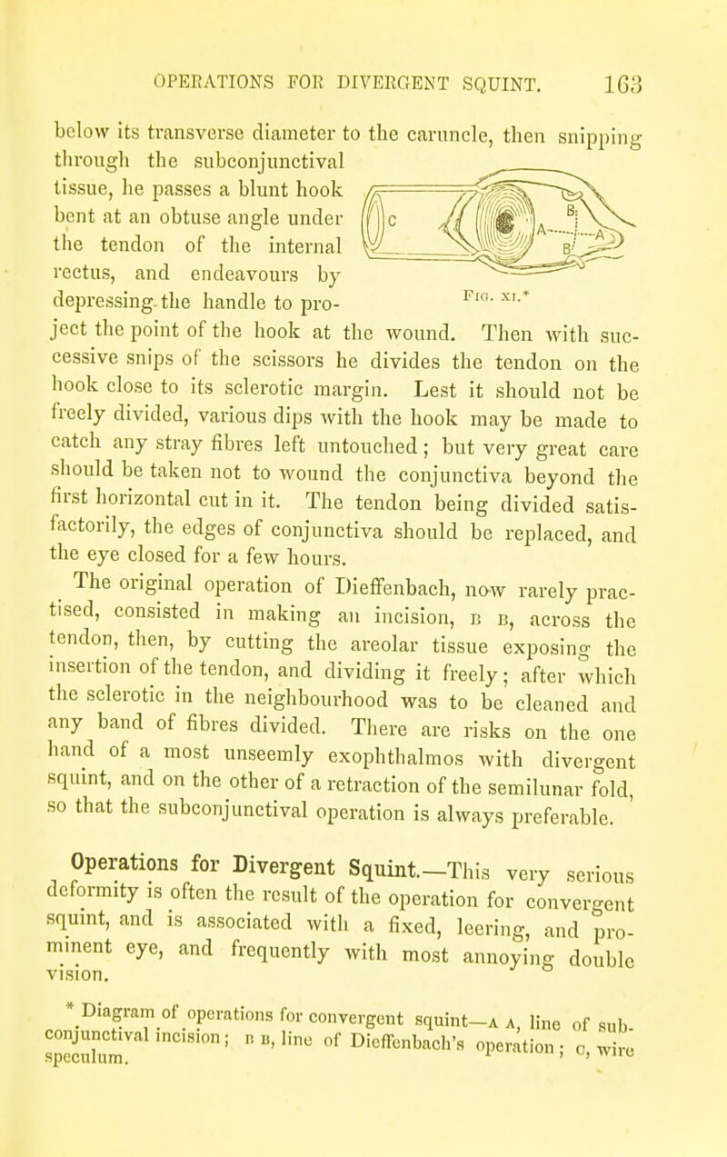 below its transverse diameter to the caruncle, then snipping through the subconjunctival tissue, he passes a blunt hook a, /v^^%r~^^X bent at an obtuse angle under (fjc /^ffffi\ \N^> the tendon of the internal \\L__ ^|S_Jp^ rectus, and endeavours by ^i^sss^ depressing.the handle to pro- Fl° XI* ject the point of the hook at the wound. Then with suc- cessive snips of the scissors he divides the tendon on the hook close to its sclerotic margin. Lest it should not be freely divided, various dips with the hook may be made to catch any stray fibres left untouched; but very great care should be taken not to wound the conjunctiva beyond the first horizontal cut in it. The tendon being divided satis- factorily, the edges of conjunctiva should be replaced, and the eye closed for a few hours. ^ The original operation of Dieffenbach, now rarely prac- tised, consisted in making an incision, b b, across the tendon, then, by cutting the areolar tissue exposing the insertion of the tendon, and dividing it freely; after which the sclerotic in the neighbourhood was to be cleaned and any band of fibres divided. There are risks on the one hand of a most unseemly exophthalmos with divergent squint, and on the other of a retraction of the semilunar fold, so that the subconjunctival operation is always preferable. Operations for Divergent Squint.-This very serious deformity is often the result of the operation for convergent squint, and is associated with a fixed, leering, and pro- mment eye, and frequently with most annoying double vision. ^Diagram of operations for convergent squint-A a, line of sub spSm nC181°n; BB'line °f Dieffenbach's nation; o, wire