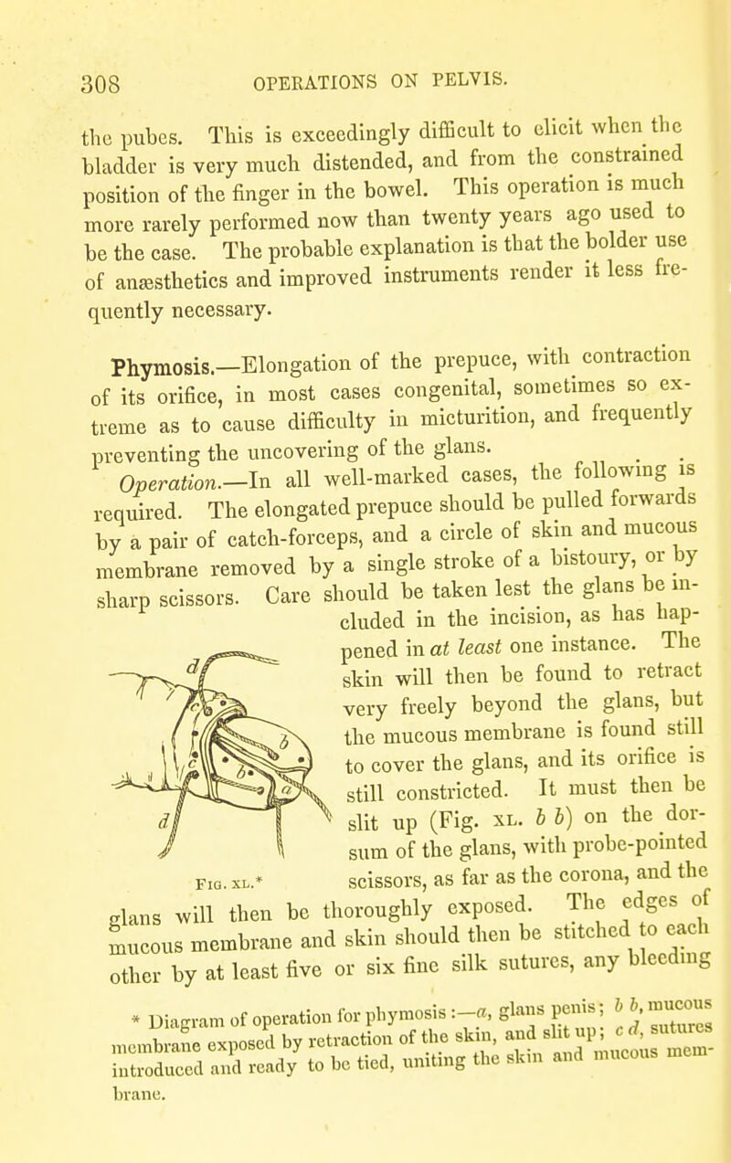 the pubes. This is exceedingly difficult to elicit when the bladder is very much distended, and from the constrained position of the finger in the bowel. This operation is much more rarely performed now than twenty years ago used to be the case. The probable explanation is that the bolder use of anesthetics and improved instruments render it less fre- quently necessary. Phymosis.—Elongation of the prepuce, with contraction of its orifice, in most cases congenital, sometimes so ex- treme as to cause difficulty in micturition, and frequently preventing the uncovering of the glans. Operation—In all well-marked cases, the following is required. The elongated prepuce should be pulled forwards by a pair of catch-forceps, and a circle of skin and mucous membrane removed by a single stroke of a bistoury or by sharp scissors. Care should be taken lest the glans be in- cluded in the incision, as has hap- pened in at least one instance. The skin will then be found to retract very freely beyond the glans, but the mucous membrane is found still to cover the glans, and its orifice is still constricted. It must then be slit up (Fig. xl. I b) on the dor- sum of the glans, with probe-pointed fig. xl.* scissors, as far as the corona, and the dans will then be thoroughly exposed. The edges of Lcous membrane and skin should then be stitched o each other by at least five or six fine silk sutures, any bleeding * Diagram of operation for phymosis :-a, glans penis; t b mucous membrane exposed by retraction of the skm, anf^^^. introduced and ready to be tied, uniting the sk.n and mucous mem brane.