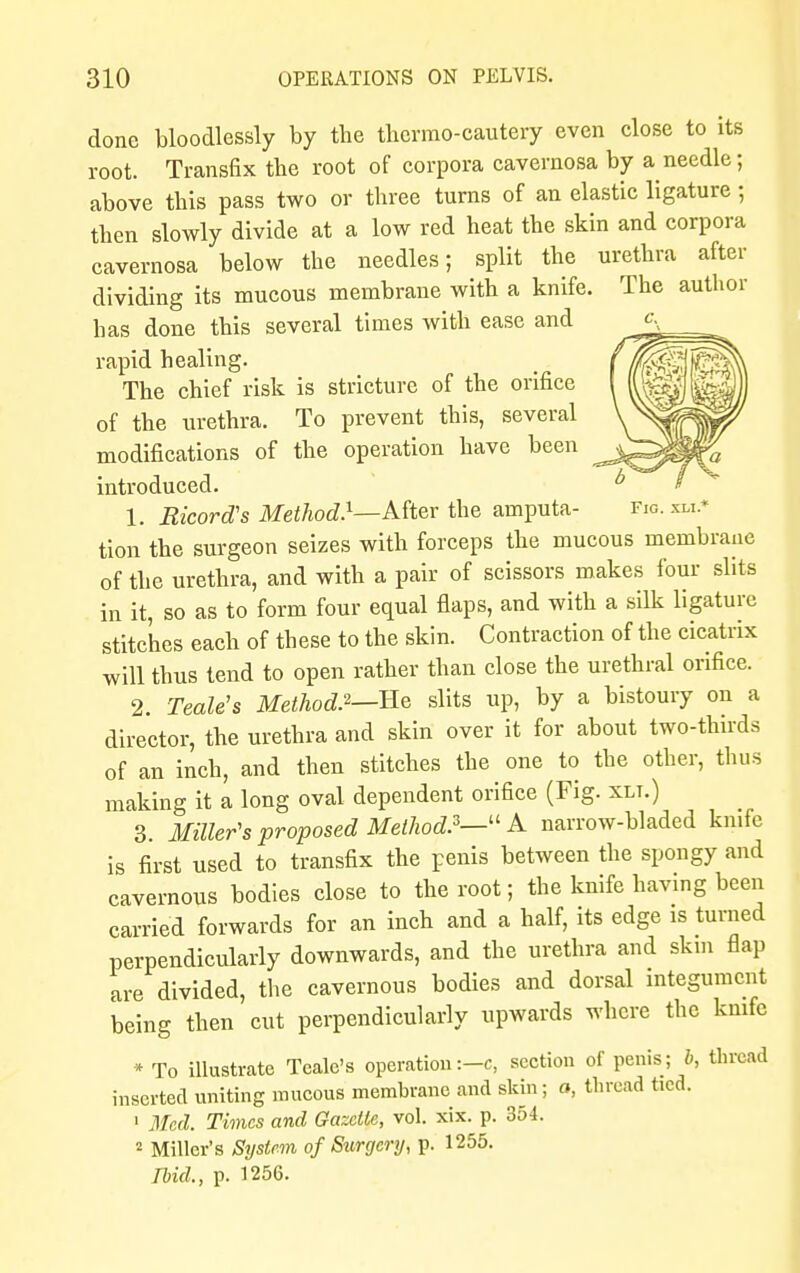 Fig. xli.* done bloodlessly by the thermo-cautery even close to its root. Transfix the root of corpora cavernosa by a needle; above this pass two or three turns of an elastic ligature; then slowly divide at a low red heat the skin and corpora cavernosa below the needles; split the urethra after dividing its mucous membrane with a knife. The author has done this several times with ease and rapid healing. The chief risk is stricture of the orifice of the urethra. To prevent this, several modifications of the operation have been introduced. 1. RicorcCs Method.1—After the amputa- tion the surgeon seizes with forceps the mucous membraue of the urethra, and with a pair of scissors makes four slits in it, so as to form four equal flaps, and with a silk ligature stitches each of these to the skin. Contraction of the cicatrix will thus tend to open rather than close the urethral orifice. 2. Teale's Method.2—He slits up, by a bistoury on a director, the urethra and skin over it for about two-thirds of an inch, and then stitches the one to the other, thus making it a long oval dependent orifice (Fig. xlt.) 3. Miller's proposed Method.3— A narrow-bladed knife is first used to transfix the penis between the spongy and cavernous bodies close to the root; the knife having been carried forwards for an inch and a half, its edge is turned perpendicularly downwards, and the urethra and skm flap are divided, the cavernous bodies and dorsal integument being then cut perpendicularly upwards where the knife * To illustrate Tcalc's operation:-c, section of penis; b, thread inserted uniting mucous membrane and skin; a, thread tied. 1 Med. Times and Gazette, vol. xix. p. 3o4. 2 Miller's System of Surgery, p. 1255. Ibid., p. 1256.