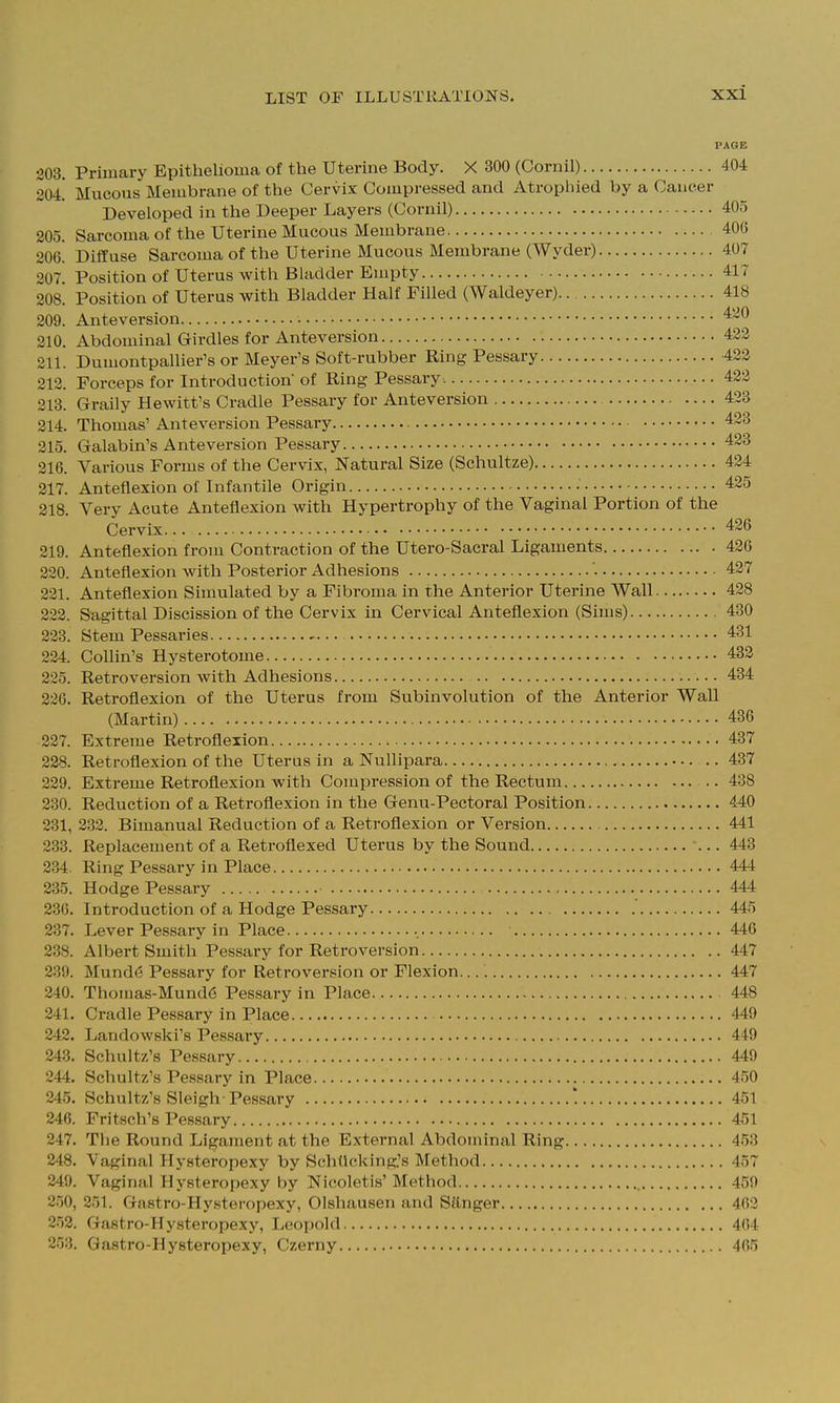 PAGE 203. Primary Epithelioma of the Uterine Body. X 300 (Cornil) 404 204 Mucous Membrane of the Cervix Compressed and Atropliied by a Cancer Developed in the Deeper Layers (Cornil) 405 205. Sarcoma of the Uterine Mucous Membrane 406 206. Diffuse Sarcoma of the Uterine Mucous Membrane (Wyder) 407 207. Position of Uterus with Bladder Empty 417 208. Position of Uterus with Bladder Half Filled (Waldeyer) 418 209. Anteversion 210. Abdominal Girdles for Anteversion 423 211. Dumontpallier's or Meyer's Soft-rubber Ring Pessary 422 212. Forceps for Introduction of Ring Pessary 422 213. Graily Hewitt's Cradle Pessary for Anteversion 423 214. Thomas' Anteversion Pessary 423 215. Galabin's Anteversion Pessary 423 216. Various Forms of the Cervix, Natural Size (Schultze) 424 217. Anteflexion of Infantile Origin • 425 218. Very Acute Anteflexion with Hypertrophy of the Vaginal Portion of the Cervix 426 219. Anteflexion from Contraction of the Utero-Sacral Ligaments 426 220. Anteflexion with Posterior Adhesions 427 221. Anteflexion Simulated by a Fibroma in the Anterior Uterine Wall 428 222. Sagittal Discission of the Cervix in Cervical Anteflexion (Sims) 430 223. Stem Pessaries 431 224 Collin's Hysterotome 432 225. Retroversion with Adhesions 434 226. Retroflexion of the Uterus from Subinvolution of the Anterior Wall (Martin) 436 227. Extreme Retroflexion 437 228. Retroflexion of the Uterus in a Nullipara 437 229. Extreme Retroflexion with Compression of the Rectum .. 438 230. Reduction of a Retroflexion in the Genu-Pectoral Position 440 231. 332. Bimanual Reduction of a Retroflexion or Version 441 233. Replacement of a Retroflexed Uterus by the Sound ... 443 234. Ring Pessary in Place 444 235. Hodge Pessary 444 236. Introduction of a Hodge Pessary 445 237. Lever Pessary in Place 446 238. Albert Smith Pessary for Retroversion 447 239. Mund6 Pessary for Retroversion or Flexion. 447 240. Thomas-Mund6 Pessary in Place 448 241. Cradle Pessary in Place 449 242. Landowski's Pessary 449 243. Schultz's Pessary 449 244. Schultz's Pe.ssary in Place 450 245. Schultz's Sleigh Pessary 1 451 246. Fritsch's Pessary 451 247. Tlie Round Ligament at the External Abdominal Ring 453 248. Vaginal Hysteropexy by Schtlcking.'s Method 457 349. Vaginal Hysteropexy by Nicoletis'Method 459 250, 251. Gastro-Hysteropexy, Olshausen and Sttnger 462 252. Gastro-Hysteropexy, Leopold 464 253. Gastro-Hysteropexy, Czerny 465