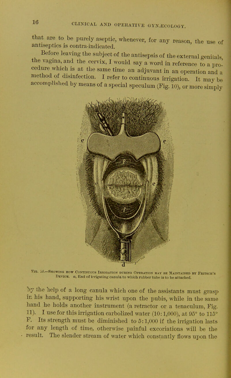 that are to be purely aseptic, whenever, for any reason, the use of antiseptics is contra-indicated. Before leaving the subject of the antisepsis of the external genitals the vagina, and the cervix, I would say a word in reference to a pro- cedure which is at the same time an adjuvant in an operation and a method of disinfection. I refer to continuous irrigation. It may be accoBiplished by means of a special speculum (Fig. 10), or more simply Vi9. 10.—Showing how Continuous iRnioATiON during Operation may be Maintained by Fritsch's Device, o, End of irrigating canula to which rubber tube is to be attached. by the lielp of a long canula Avhich one of the assistants must grasi> in his hand, supporting his wrist upon the pubis, while in the same hand he holds another instrument (a retractor or a tenaculum. Fig. 11). I use for this irrigation carbolized Avater (10:1,000), at 95° to 115° F. Its strength must be diminished to 5:1,000 if the irrigation lasts for any length of time, otherwise painful excoriations will be the result. The slender stream of water which constantly flows upon the