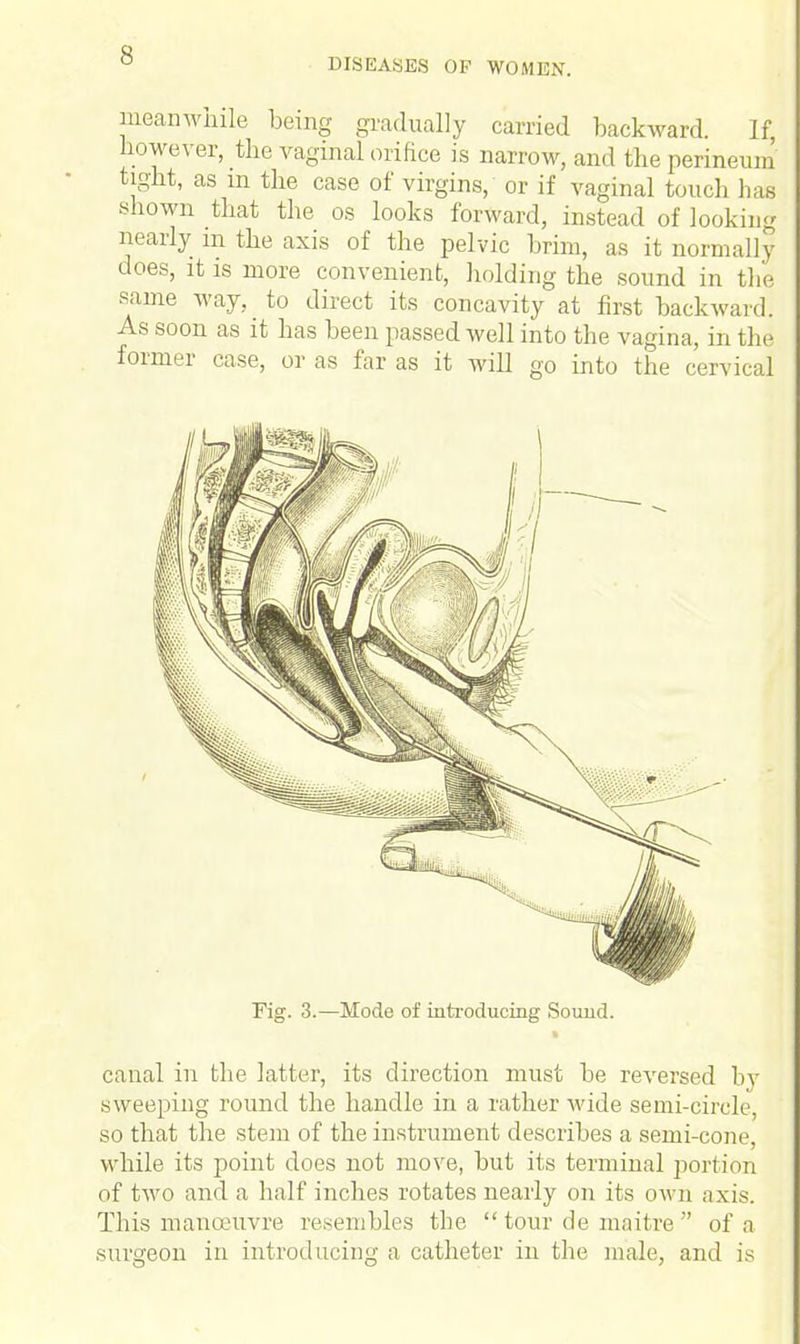 DISEASES OF WOMEN. meanwhile being gradually carried backward. If, however, the vaginal orifice is narrow, and the perineum tight, as m the case of virgins, or if vaginal touch has shown that the os looks forward, instead of looking nearly m the axis of the pelvic brim, as it normally does, it is more convenient, holding the sound in the same way, to direct its concavity at first backward. As soon as it has been passed well into the vagina, in the former case, or as far as it will go into the cervical Fig. 3.—Mode of introducing Sound. canal in the latter, its direction must be reversed by sweeping round the handle in a rather wide semi-circle, so that the stem of the instrument describes a semi-cone, while its point does not move, but its terminal portion of two and a half inches rotates nearly on its own axis. This manoeuvre resembles the  tour de maitre  of a surgeon in introducing a catheter in the male, and is