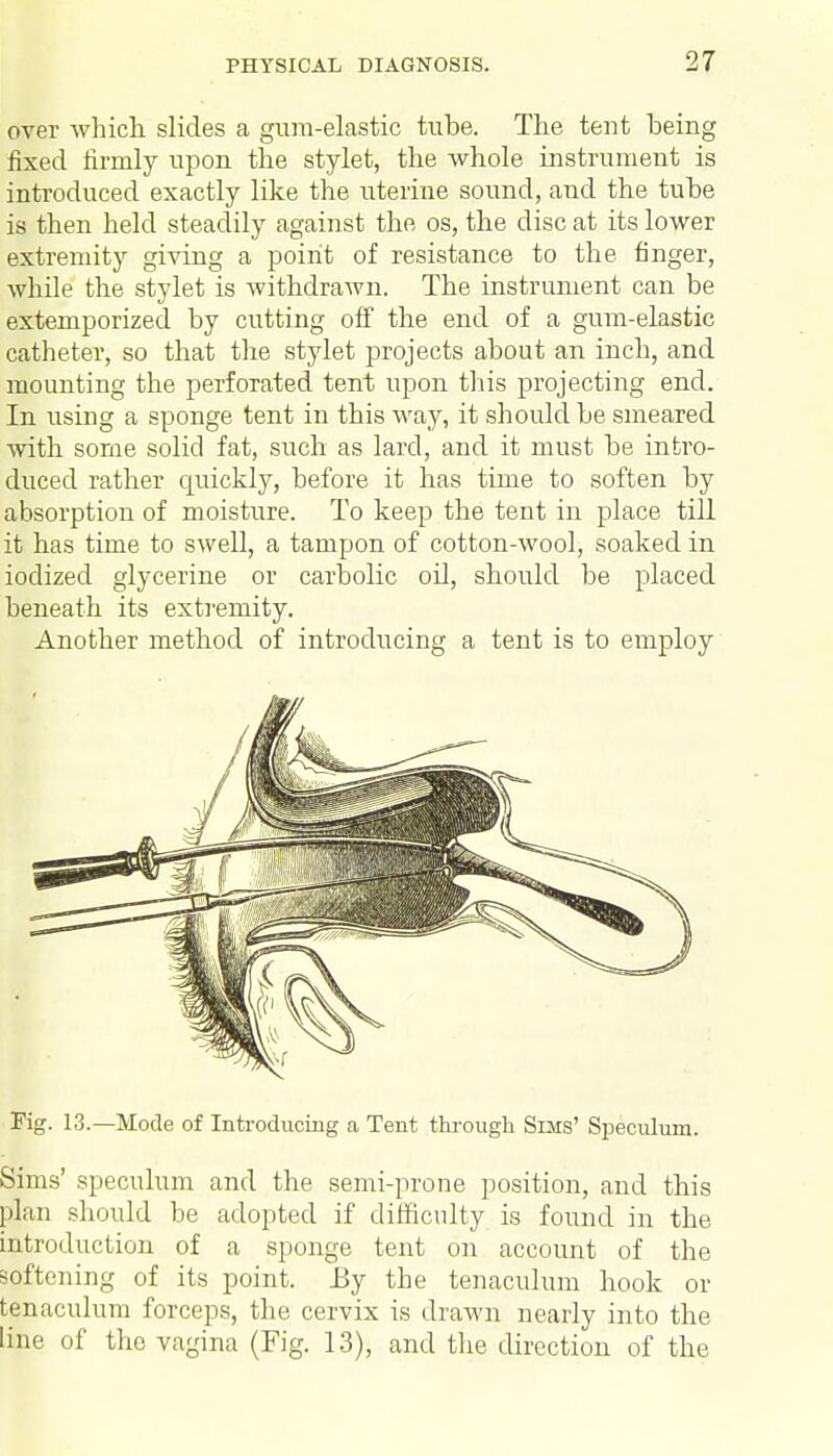 over which slides a gum-elastic tube. The tent being fixed firmly upon the stylet, the whole instrument is introduced exactly like the uterine sound, and the tube is then held steadily against the os, the disc at its lower extremity giving a point of resistance to the finger, while the stylet is withdrawn. The instrument can be extemporized by cutting off the end of a gum-elastic catheter, so that the stylet projects about an inch, and mounting the perforated tent upon this projecting end. In using a sponge tent in this way, it should be smeared with some solid fat, such as lard, and it must be intro- duced rather quickly, before it has time to soften by absorption of moisture. To keep the tent in place till it has time to swell, a tampon of cotton-wool, soaked in iodized glycerine or carbolic oil, should be placed beneath its extremity. Another method of introducing a tent is to employ Fig. 13.—Mode of Introducing a Tent through Sims' Speculum. Sims' speculum and the semi-prone position, and this plan should be adopted if difficulty is found in the introduction of a sponge tent on account of the softening of its point. By the tenaculum hook or t|naculum forceps, the cervix is drawn nearly into the line of the vagina (Fig. 13), and the direction of the