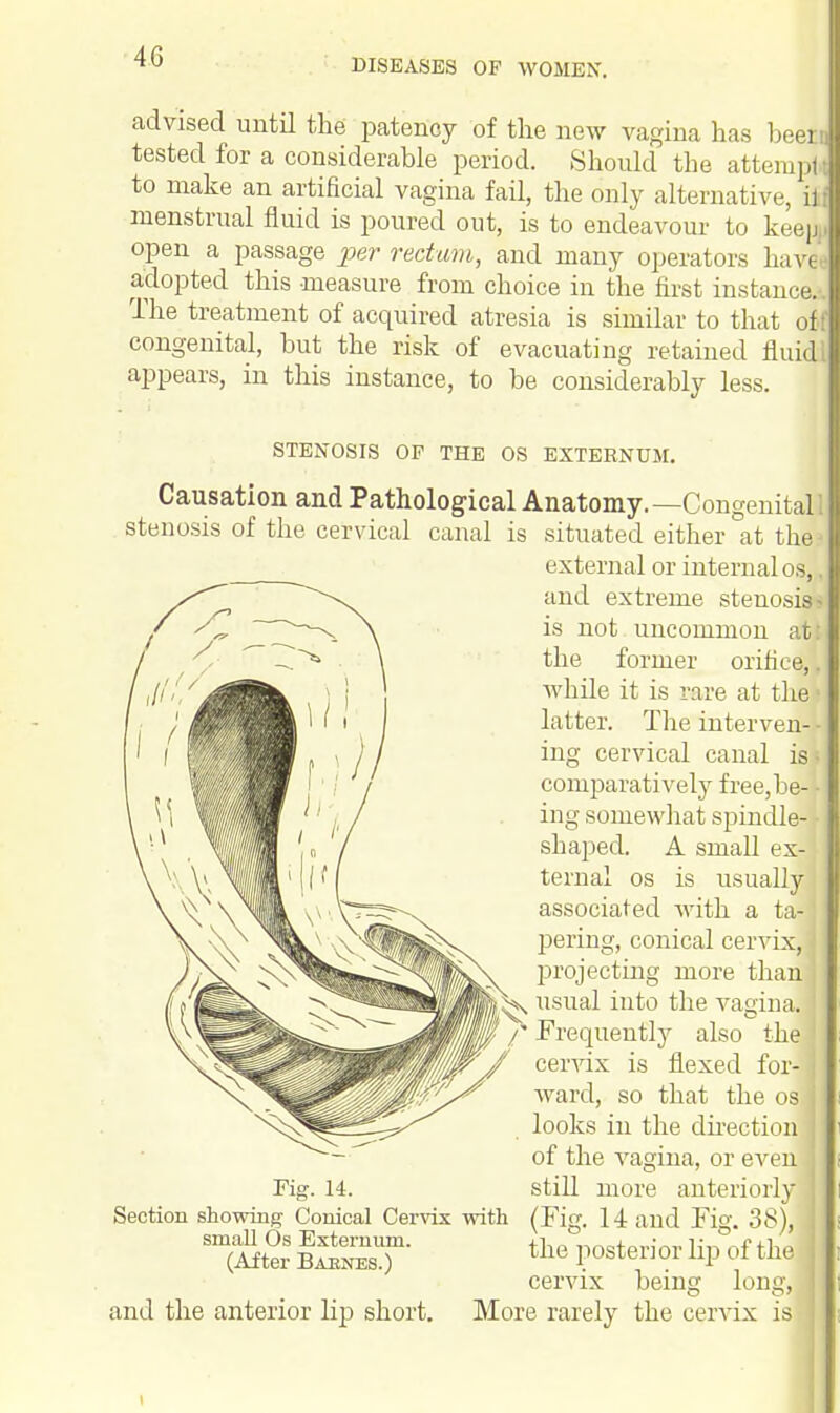 4G DISEASES OF WOMEN. advised until the patency of the new vagina has been tested for a considerable period. Should the attempt to make an artificial vagina fail, the only alternative, ill menstrual fluid is poured out, is to endeavour to keej open a passage per rectum, and many operators havl adopted this measure from choice in the first instance. The treatment of acquired atresia is similar to that off congenital, but the risk of evacuating retained fluid 1 appears, in this instance, to be considerably less. STENOSIS OP THE OS EXTERNUM. Causation and Pathological Anatomy.—Congenital stenosis of the cervical canal Fig. 14. Section showing Conical Cervix with small Os Externum. (After Barnes.) and the anterior lip short. situated either at the external or internal os, J and extreme stenosis? is not uncommon attj the former orifice,. while it is rare at tin* latter. The interven- ing cervical canal is comparatively free,be- ing somewhat spindle- shaped. A small ex- ternal os is usually associated with a ta- pering, conical cervix, I projecting more than ^ usual into the vagina. Frequently also the cervix is flexed for- ward, so that the osl looks in the direction i of the vagina, or even still more anteriorly (Fig. Hand Fig. 38), the posterior lip of the cervix being long, More rarely the cervix is