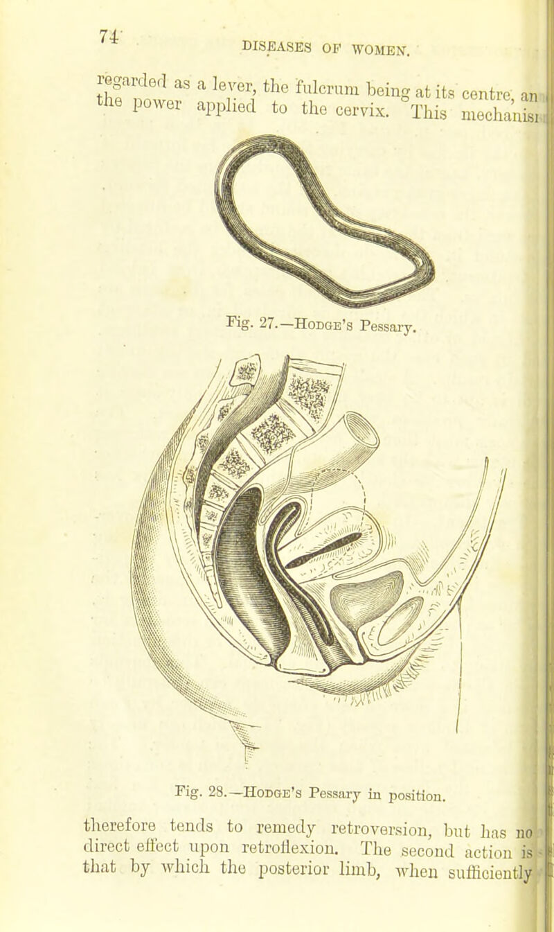 DISEASES OF WOMEN. regarded as a lever, the fulcrum being at its centre an the power applied to the cervix. °This 3J Fig. 27.—Hodge's Pessary. Fig. 28.—Hodge's Pessary in position. therefore tends to remedy retroversion, but has no direct effect upon retroflexion. The second action is that by which the posterior limb, when sufficient 1