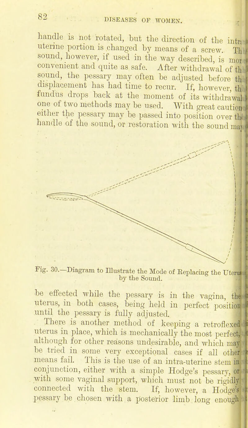 DISEASES OF WOMEN'. handle is not rotated, but the direction of the intru uterine portion is changed by means of a screw Thi sound, however, if used in the way described, is nior J convenient and quite as safe. After withdrawal of th 0 sound, the pessary may often be adjusted before thi] displacement has had time to recur. If, however flfl fundus drops back at the moment of its withdrawal I one of two methods may be used. With great caution ! either the pessary may be passed into position over tin] handle of tho sound, or restoration with the sound raajl ig. 30.—Diagram to Illustrate the Mode of Keplacuig the TJtert by the Sound. be effected while the pessary is in the vagina, thU uterus, in both cases, being held in perfect position! until the pessary is fully adjusted. There is another method of keeping a retroflexi uterus in place, which is mechanically the most perfe^H although for other reasons undesirable, and which mam be tried in some very exceptional cases if all other fl means fail. This is the use of an intra-uterine stem itim conjunction, either with a simple Hodge's pessary, oil with some vaginal support, which must not be rigidly connected with the stem. If, however, a HodgaH pessary be chosen with a posterior limb long enough i