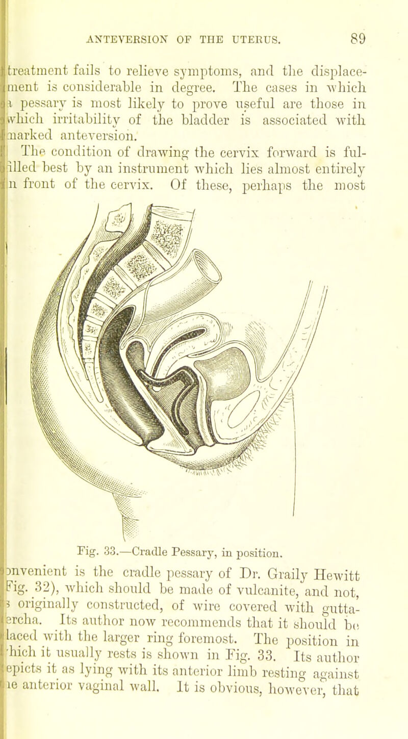 treatment fails to relieve symptoms, and the displace- ment is considerable in degree. The cases in which p, pessary is most likely to prove useful are those in which irritability of the bladder is associated with narked anteversion. The condition of drawing the cervix forward is ful- filled best by an instrument which lies almost entirely In front of the cervix. Of these, perhaps the most Fig. 33.—Cradle Pessary, in position. Dnvenient is the cradle pessary of Dr. Graily Hewitt Fig. 32), which should be made of vulcanite, and not, 5 originally constructed, of wire covered with gutta- ercha. Its author now recommends that it should be laced with the larger ring foremost. The position in Jllich it usually rests is shown in Fig. 33. Its author epicts it as lying with its anterior limb resting against le anterior vaginal wall. It is obvious, however, that