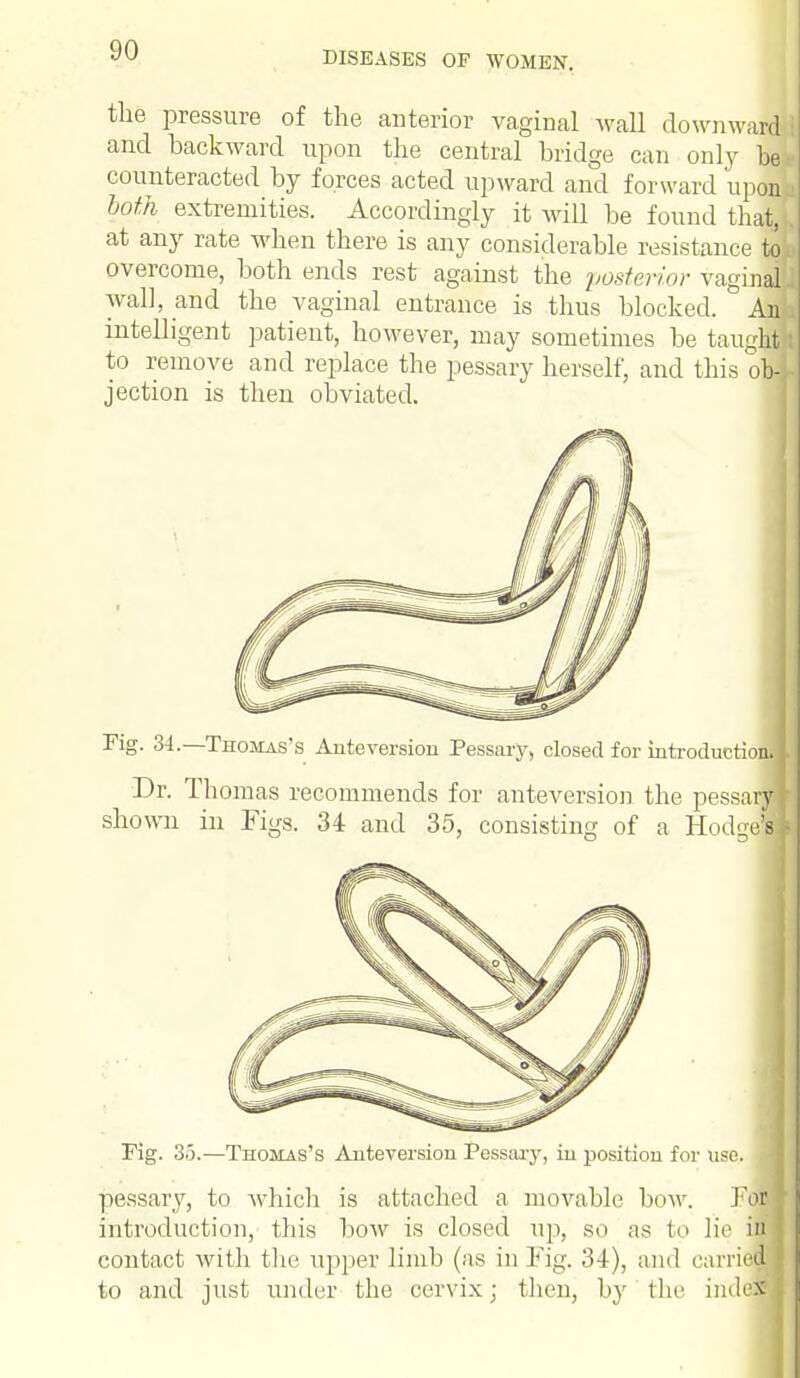 the pressure of the anterior vaginal Avail downward*! and backward upon the central bridge can only bee counteracted by forces acted upward and forward upon i both extremities. Accordingly it will be found that, . at any rate when there is any considerable resistance too overcome, both ends rest against the posterior vaginal ] wall, and the vaginal entrance is thus blocked. An i intelligent patient, however, may sometimes be taught I to remove and replace the pessary herself, and this obi] jection is then obviated. Fig. 34.—Thomas's Auteversion Pessary, closed for introductioiflj Dr. Thomas recommends for auteversion the pessarwj shown in Figs. 34 and 35, consisting of a HodgeJ Fig. 35.—Thomas's Auteversion Pessary, in position for use. pessary, to which is attached a movable bow. Tot introduction, this bow is closed up, so as to lie ilp contact with the upper limb (as in Fig. 34), and carried to and just under the cervix; then, by the index