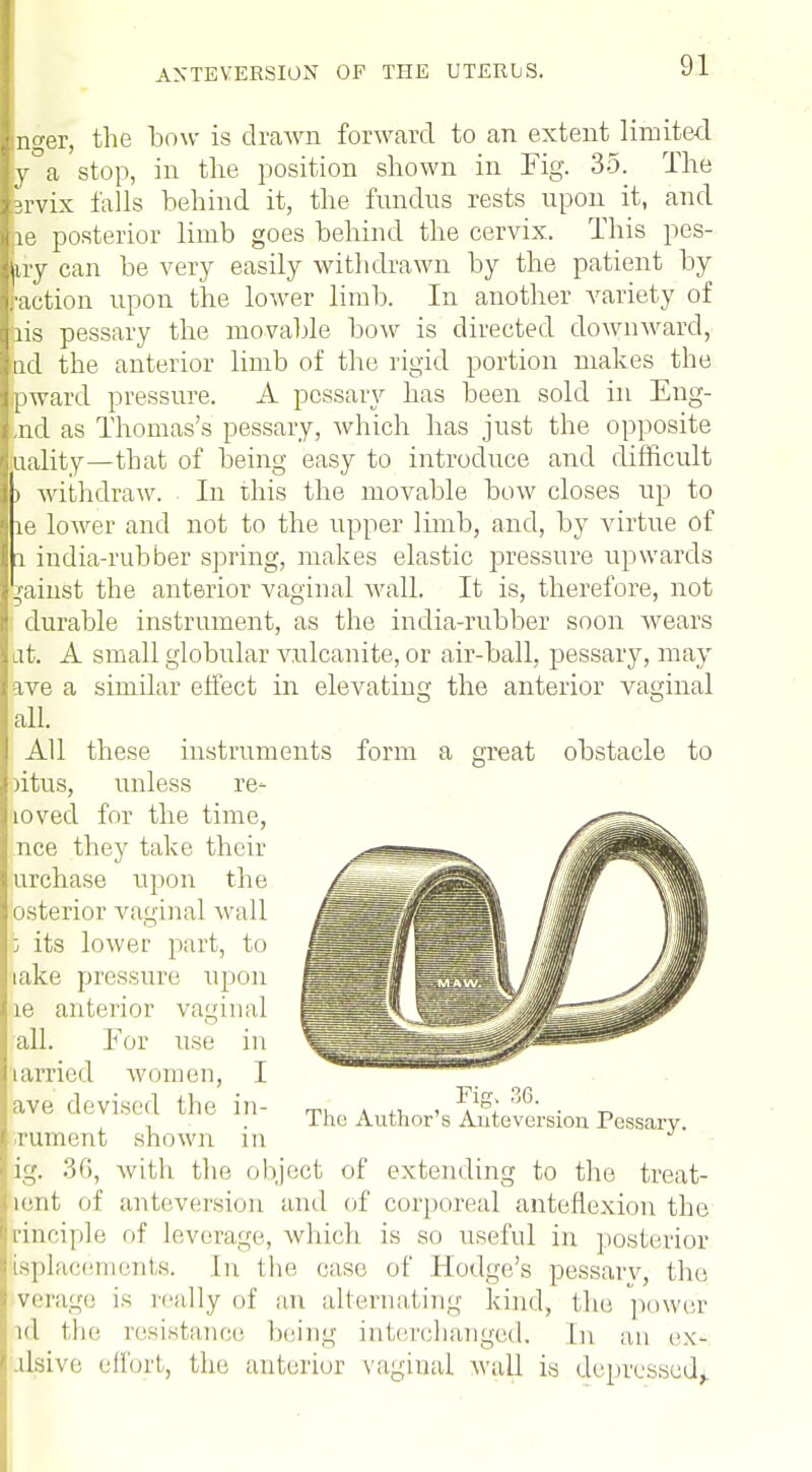 inger, the bow is drawn forward to an extent limited y a stop, in the position shown in Fig. 35. The rvix falls behind it, the fundus rests upon it, and le posterior limb goes behind the cervix. This pes- liy can be very easily withdrawn by the patient by action upon the lower limb. In another variety of lis pessary the movable bow is directed downward, d the anterior limb of the rigid portion makes the pward pressure. A pessary has been sold in Eng- nd as Thomas's pessary, which has just the opposite uality—that of being easy to introduce and difficult > withdraw. In this the movable bow closes up to ie lower and not to the upper limb, and, by virtue of i iudia-rnbber spring, makes elastic pressure upwards gainst the anterior vaginal wall. It is, therefore, not durable instrument, as the india-rubber soon wears at. A small globular vulcanite, or air-ball, pessary, may ave a similar effect in elevating the anterior vaginal all. All these instruments form )itus, unless re- loved for the time, nee they take their urchase upon the osterior vaginal wall b its lower part, to take pressure upon ie anterior vaginal all. For use in tarried women, I ave devised the ili- niment shown in ig. 36, Avith the object of extending to the treat- pent of ante version and of corporeal anteflexion the rinciple of leverage, which is so useful in posterior isplacements. In the case of Hodge's pessary, the verage is really of an alternating kind, the power id the resistance being interchanged, in an c\- ilsivc. effort, the, anterior vaginal wall is depressed,. a great obstacle to The Author's Auteversion Pessary.