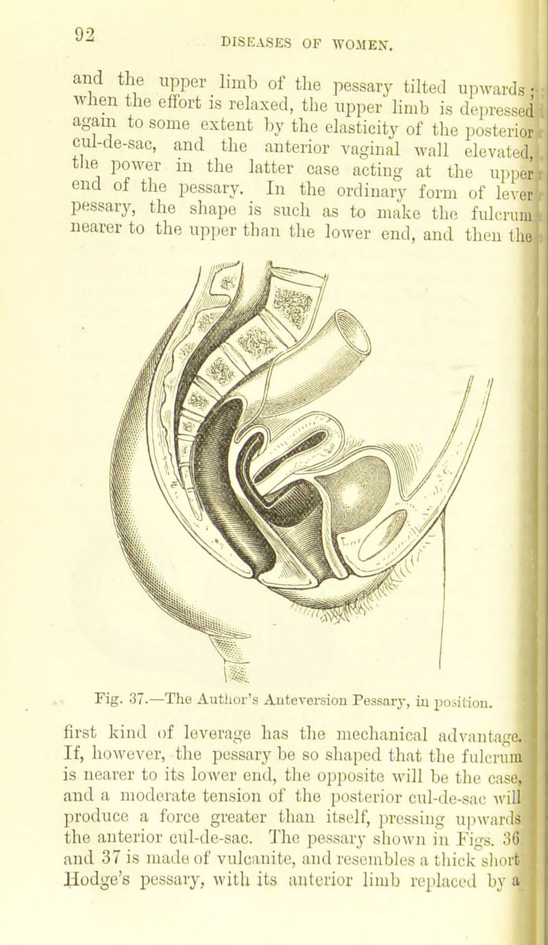 DISEASES OF WOMEN. and the upper limb of the pessary tilted upwards i when the effort is relaxed, the upper limb is depressed again to some extent by the elasticity of the posterior cul-de-sac, and the anterior vaginal wall elevated the power m the latter case acting at the upper end of the pessary. In the ordinary form of lever: pessary, the shape is such as to make the fulcrum! nearer to the upper than the lower end, and then the Fig. 37.—The Author's Auteversiou Pessary, in position. first kind of leverage has the mechanical advantage. If, however, the pessary be so shaped that the fulcrum is nearer to its lower end, the opposite will be the case, and a moderate tension of the posterior cul-de-sac will produce a force greater than itself, pressing upwards the anterior cul-de-sac. The pessary shown in Fii^s. 36j and 37 is made of vulcanite, and resembles a thick short Hodge's pessary, with its anterior limb replaced by a