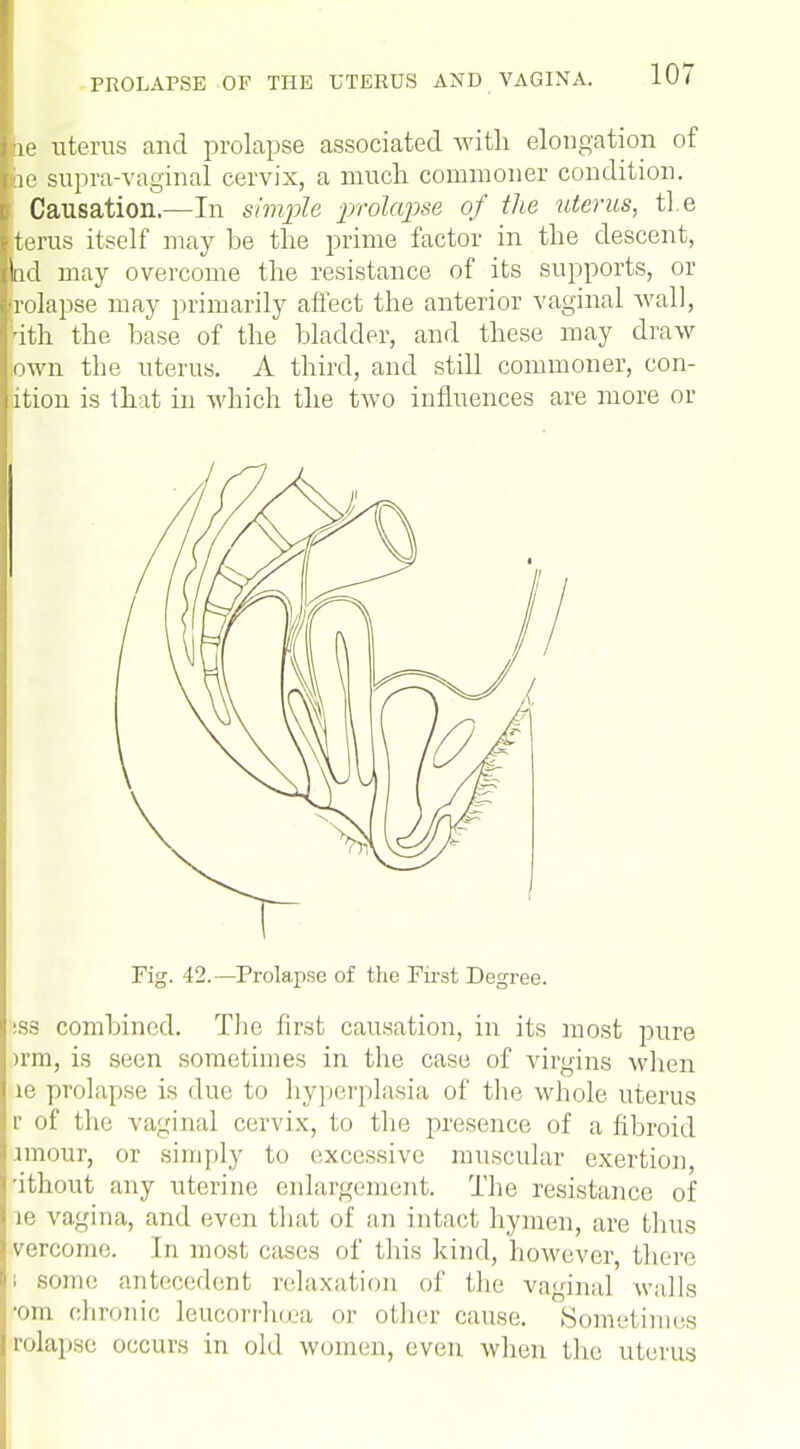 ie uterus and prolapse associated with elongation of e supra-vaginal cervix, a much commoner condition. Causation.—In simple prolapse of the uterus, ti e fcerus itself may be the prime factor in the descent, d may overcome the resistance of its supports, or rolapse may primarily affect the anterior vaginal Avail, ith the base of the bladder, and these may draw lown the uterus. A third, and still commoner, con- ition is that in which the two influences are more or Fig. 42.—Prolapse of the First Degree. sss combined. The first causation, in its most pure )rm, is seen sometim es in the case of virgins when ie prolapse is due to hyperplasia of the whole uterus r of the vaginal cervix, to the presence of a fibroid amour, or simply to excessive muscular exertion, 'ithout any uterine enlargement. The resistance of ie vagina, and even that of an intact hymen, are thus vercome. In most cases of this kind, however there some antecedent relaxation of the vaginal walls •om chronic leucorrhoea or other cause. Sometimes rolapse occurs in old women, even when the uterus