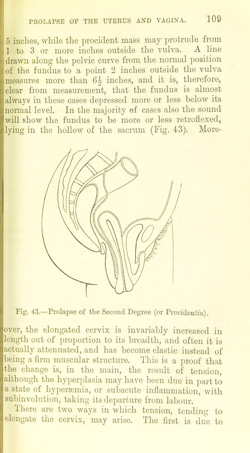 5 inches, while the procident mass may protrude from 1 to 3 or more inches outside the vulva. A line drawn along the pelvic curve from the normal position of the fundus to a point 2 inches outside the vulva measures more than 6| inches, and it is, therefore, clear from measurement, that the fundus is almost always in these cases depressed more or less helow its normal level. In the majority ef cases also the sound will show the fundus to he more or less retrofiexed, lying in the hollow of the sacrum (Fig. 43). More- Fig. 43.—Prolapse of the Second Degree (or Procidentia). over, the elongated cervix is invariably increased in length out of proportion to its breadth, and often it is actually attenuated, and has become elastic instead of being a firm muscular structure. This is a proof that the change is, in the main, the result of tension, although the hyperplasia may have been due in part to a state of hyperemia, or subacute inflammation, with subinvolution, taking its departure from labour. There are two ways in which tension, tending to elongate the cervix, may arise. The first is due to