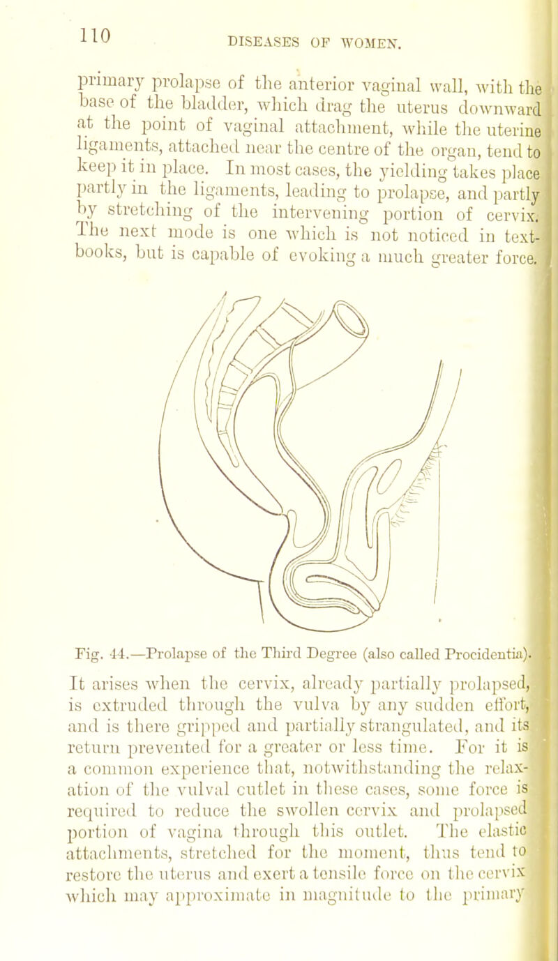 DISEASES OF WOMEN. primary prolapse of the anterior vaginal wall, with the base of the bladder, which drag the uterus downward at the point of vaginal attachment, while the uterine ligaments, attached near the centre of the organ, tend to keep it in place. In most cases, the yielding'takes place partly in the ligaments, leading to prolapse, and partly by stretching of the intervening portion of cervix. The next mode is one which is not noticed in text- books, but is capable of evoking a much greater force! Fig. 14.—Prolapse of the Third Degree (also called Procidentia). It arises when the cervix, already partially prolapsecu is extruded through the vulva by any sudden effort, and is there gripped and partially strangulated, and its return prevented for a greater or less time. For it is a common experience that, notwithstanding the relax- ation of the vulval cutlet in these cases, some force is required to reduce the swollen cervix and prolapsed portion of vagina through this outlet. The elastic attachments, stretched for the moment, thus tend to restore the uterus and exert a tensile force mi the cervix which may approximate in magnitude to the primary