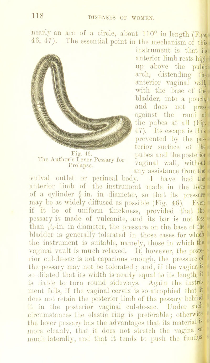 Fig. 46. The Author's Lever Pessary for Prolapse. nearly an arc of a circle, about 110° in length (Fisjl 46, 47). The essential point in the mechanism of this instrument is that fl anterior limli rests high i up above the pubiftl arch, distending than anterior vaginal waUIJ with the base of the bladder, into a pouclm and does not press against the rami of the pubes at all (Ffl 47). Its escape is thus ■ prevented by the pos- • terior surface of thnj pubes and the posterior vaginal wall, without ! any assistance from the i vulval outlet or perineal body. I have had tlflj anterior limb of the instrument made in the forW of a cylinder |-in. in diameter, so that its pressure may be as widely diffused as possible (Fig. 46). Evfl if it be of uniform thickness, provided that the pessary is made of vulcanite, and its bar is not less a than iVin. in diameter, the pressure on the base of the bladder is generally tolerated in those cases for which the instrument is suitable, namely, those in which the vaginal vault is much relaxed. If, however, the poster ■ rior cul-de-sac is not capacious enough, the pressure of the pessary may not be tolerated ; and, if the vaginaW * so dilated that its width is nearly equal to its length, it 5 is liable to turn round sideways. Again the instlfli ment fails, if the vaginal cervix is so atrophied that HI does not retain the posterior limb of the pessary behind it in the posterior vaginal cul-de-sac. ruder such circumstances the elastic ring is preferable; otherwise i the lever pessary has the advantages that its material IS more cleanly, that it does not stretch the vagina so much laterally, and that it tends to push the fundus