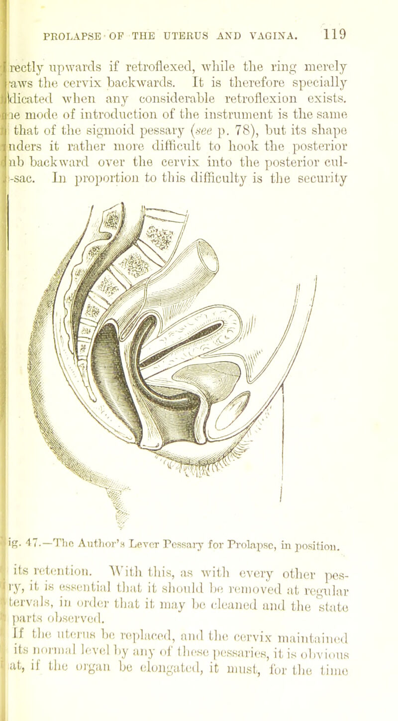 rectly upwards if retroflexed, while the ring merely ■aws the cervix backwards. It is therefore specially Idicated when any considerable retroflexion exists, ae mode of introduction of the instrument is the same that of the sigmoid pessary (see p. 78), but its shape nders it rather more difficult to hook the posterior nb backward over the cervix into the posterior cul- :-sac. In proportion to this difficulty is the security ig. 47.— The Author's Lever Pessary for Prolapse, in position. its retention. With this, as with every other pes- ry, it is essentia] that it should be removed at retmlar tervals, in order that it may be cleaned and the state parts observed. If the uterus be replaced, and the cervix maintained its normal level by any of these pessaries, it is obvious at, if the organ be elongated, it must, for the time