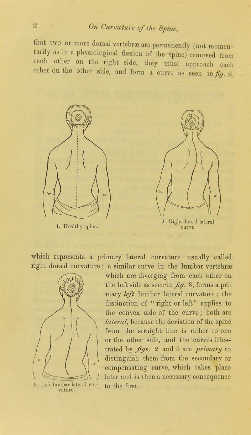 that two or more dorsal vertebrsD are permauently (not momen- tarily as in a pliysiological flexion of the spine) removed from each other on the right side, they must approach each other on the other side, and form a curve as seen in fig. 2, which represents a primary lateral curvature usually called right dorsal curvature; a similar curve in the lumbar vertebrae which are diverging from each other on the left side as seen-in Jig. 3, forms a pri- mary left lumbar lateral curvature; the distinction of right or left applies to the convex side of the curve; both are lateral, because the deviation of the spine from the straight line is either to one or the other side, and the curves illus- trated by figs. 2 and 3 are primary to distinguish them from the secondary or compensating curve, which takes place later and is then a necessary consequence 3. Left lumbar lateral cur- first, vature.