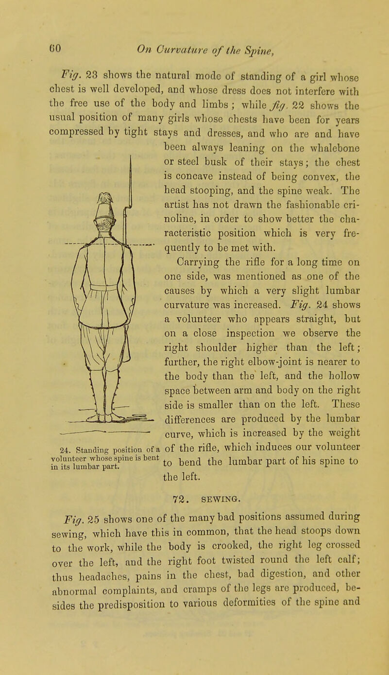 Tig. 23 shows the natural mode of standing of a girl whose chest is well developed, and whose dress does not interfere with the free use of the hody and limbs ; while Jig. 22 shows the usual position of many girls wl)ose chests have been for years compressed by tight stays and dresses, and who are and have been always leaning on the whalebone or steel busk of their stays; the chest is concave instead of being convex, tlie head stooping, and the spine weak. The artist has not drawn the fashionable cri- noline, in order to show better the cha- racteristic position which is very fre- quently to be met with. Carrying the rifle for a long time on one side, was mentioned as one of the causes by which a very slight lumbar curvature was increased. Fig. 24 shows a volunteer who appears straight, but on a close inspection we observe the right shoulder higher than the left; further, the right elbow-joint is nearer to the body than the left, and the hollow space between arm and body on the right side is smaller than on the left. These differences are produced by the lumbar curve, which is increased by the weight 24. Standing position of a of the rifle, which iuduces our volunteer L°itsiumbllTarr°^'^^^^^ ^^ud the lumbar part of his spine to the left. 72. SEWING. Fig. 25 shows one of the many bad positions assumed during sewing, which have this in common, that the head stoops down to the work, while the body is crooked, the right leg crossed over the left, and the right foot twisted round the left calf; thus headaches, pains in the chest, bad digestion, and other abnormal complaints, and cramps of the legs are produced, be- sides the predisposition to various deformities of the spine and