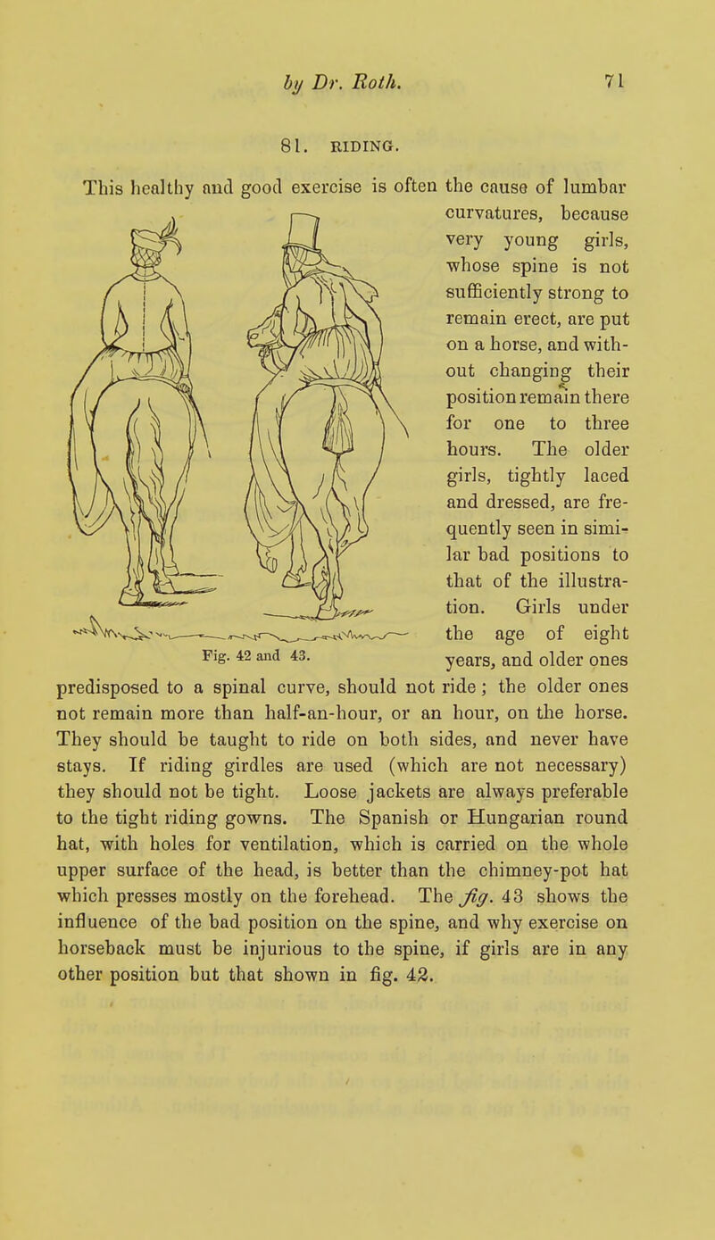 81. RIDING. This healthy and good exercise is often the cause of lumbar curvatures, because very young girls, whose spine is not sufficiently strong to remain erect, are put on a horse, and with- out changing their position remain there for one to three hours. The older girls, tightly laced and dressed, are fre- quently seen in simi-^ lar bad positions to that of the illustra- tion. Girls under the age of eight Fig. 42 and 43. years, and older ones predisposed to a spinal curve, should not ride; the older ones not remain more than half-an-hour, or an hour, on the horse. They should be taught to ride on both sides, and never have stays. If riding girdles are used (which are not necessary) they should not be tight. Loose jackets are always preferable to the tight riding gowns. The Spanish or Hungarian round hat, with holes for ventilation, which is carried on the whole upper surface of the head, is better than the chimney-pot hat which presses mostly on the forehead. Thej'^y. 43 shows the influence of the bad position on the spine, and why exercise on horseback must be injurious to the spine, if girls are in any other position but that shown in fig. 42.