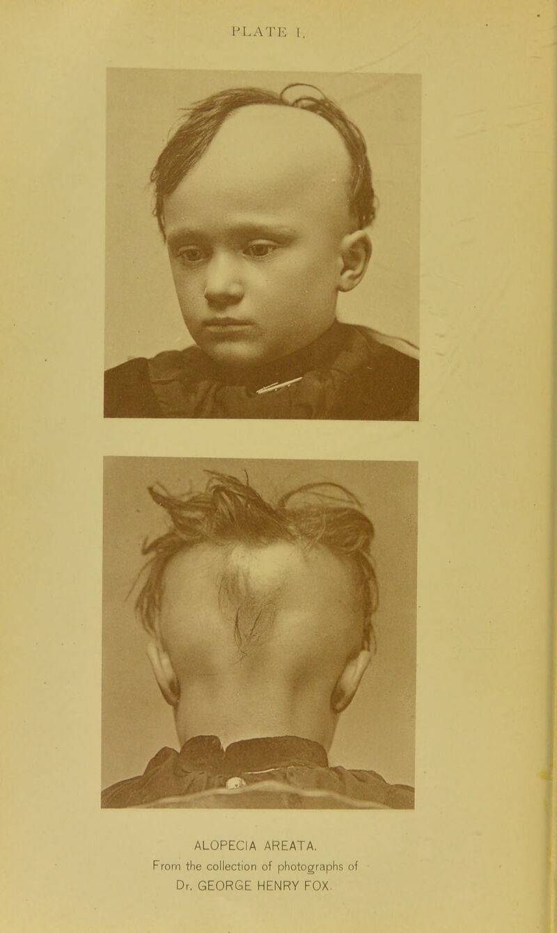 ALOPECIA AREATA. From the collection of photograph Dr. GEORGE HENRY FOX.